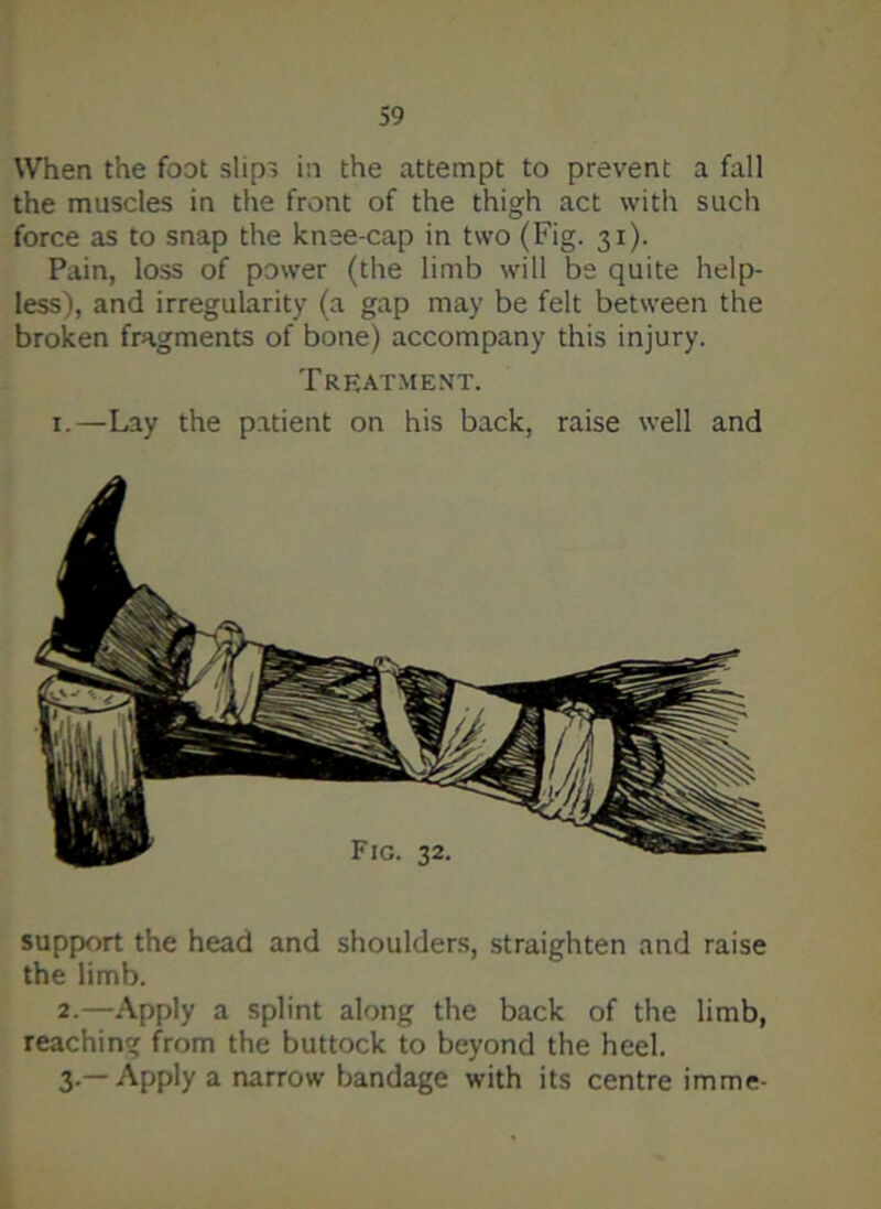 When the foot slips in the attempt to prevent a fall the muscles in the front of the thigh act with such force as to snap the knee-cap in two (Fig. 31). Pain, loss of power (the limb will be quite help- less), and irregularity (a gap may be felt between the broken fragments of bone) accompany this injury. Treatment. 1.—Lay the patient on his back, raise well and support the head and shoulders, straighten and raise the limb. 2. —Apply a splint along the back of the limb, reaching from the buttock to beyond the heel. 3. —Apply a narrow bandage with its centre imme-