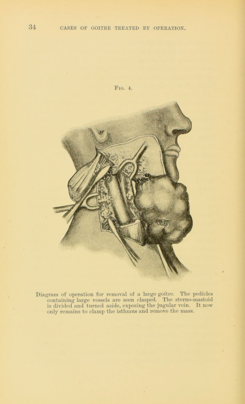 Fig. 4. Diagram of operation for removal of a large goitre. The pedicles containing large vessels are seen clasped. The sterno-mastoid is divided and turned aside, exposing the jugular vein. It now only remains to clamp the isthmus and remove the mass.