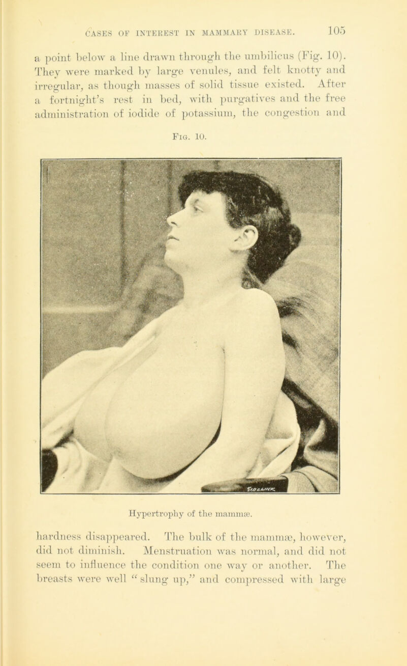 a point below a line drawn through the umbilicus (Fig. 10). They were marked by large venules, and felt knotty and irregular, as though masses of solid tissue existed. After a fortnight’s rest in bed, with purgatives and the free administration of iodide of potassium, the congestion and Fig. 10. Hypertrophy of the mammae. hardness disappeared. The bulk of the mammae, however, did not diminish. Menstruation was normal, and did not seem to influence the condition one way or another. The breasts were well “ slung up,” and compressed with large