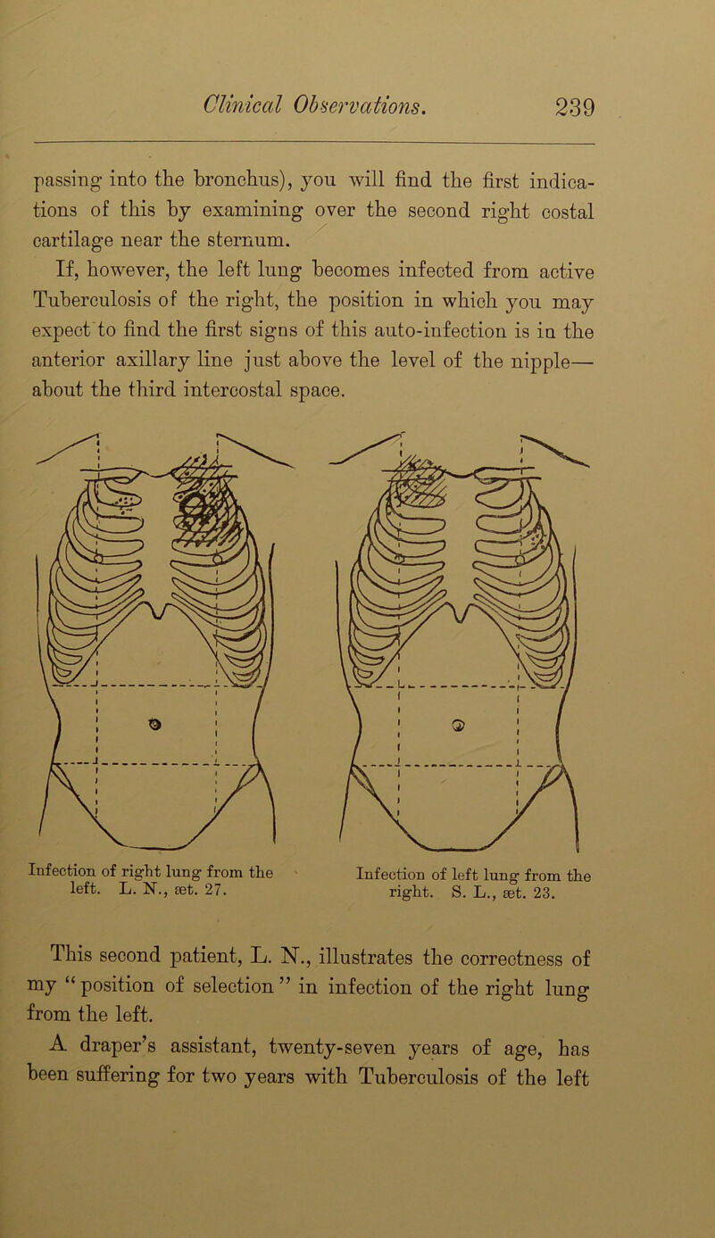 passing into the bronchus), you will find the first indica- tions of this by examining over the second right costal cartilage near the sternum. ^ If, however, the left lung becomes infected from active Tuberculosis of the right, the position in which you may expect'to find the first signs of this auto-infection is in the anterior axillary line just above the level of the nipple— about the third intercostal space. Infection of right lung from the left. L. N., eet. 27. Infection of left lung from the right. S. L., set. 23. This second patient, L. N., illustrates the correctness of my “ position of selection ” in infection of the right lung from the left. A draper’s assistant, twenty-seven years of age, has been suffering for two years with Tuberculosis of the left