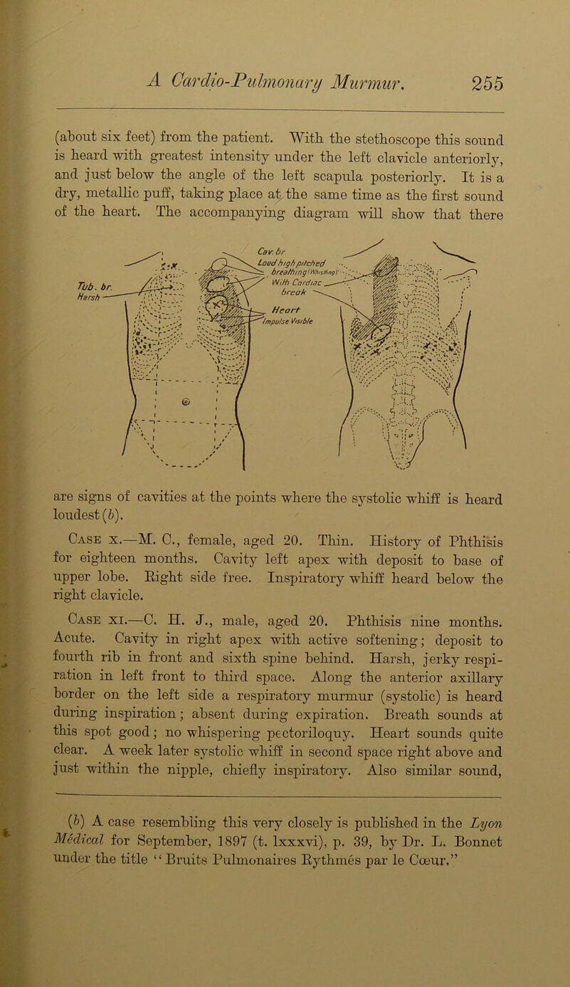 (about six feet) from the patient. With the stethoscope this sound is heard with greatest intensity under the left clavicle anteriorly, and just below the angle of the left scapula posteriorly. It is a di-y, metallic puif, taking place at, the same time as the first sound of the heart. The accompanying diagram will show that there Tub. br. Harsh Car.br Loud high pitched ^ breafhingtWhisHmg'r -):^'. With Cardiac break Heart 'impufse Visible are signs of cavities at the points where the systolic wln'fP is heard loudest (i). Case x.—M. C., female, aged 20. Thin. History of Phthisis for eighteen months. Cavity left apex with deposit to base of upper lobe. Eight side free. Inspiratory whiif heard below the right clavicle. Case xi.—C. H. J., male, aged 20. Phthisis nine months. Acute. Cavity in right apex with active softening; deposit to fourth rib in front and sixth spine behind. Harsh, jerky respi- ration in left front to third space. Along the anterior axillary border on the left side a respiratory murmur (systolic) is heard during inspiration; absent during expiration. Breath sounds at this spot good; no whispering pectoriloquy. Heart sounds quite clear. A week later systolic whiff in second space right above and just within the nipple, chiefiy inspiratory. Also similar sormd. (b) A case resembling this very closely is published in the Lyon Medical for September, 1897 (t. Ixxxvi), p. 39, by Dr. L. Bonnet under the title “ Bruits Pulmonaires Eythmes par le Coeur.”