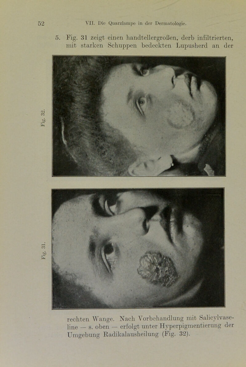 5. Fig. 31 zeigt einen handtellergroßen, derb infiltrierten, mit starken Schuppen bedeckten Lupusherd an der rechten Wange. Nach Vorbehandlung mit Salicylvase- line — s. oben — erfolgt unter Hyperpigmentierung der Umgebung Radikalausheilung (Fig. 32).