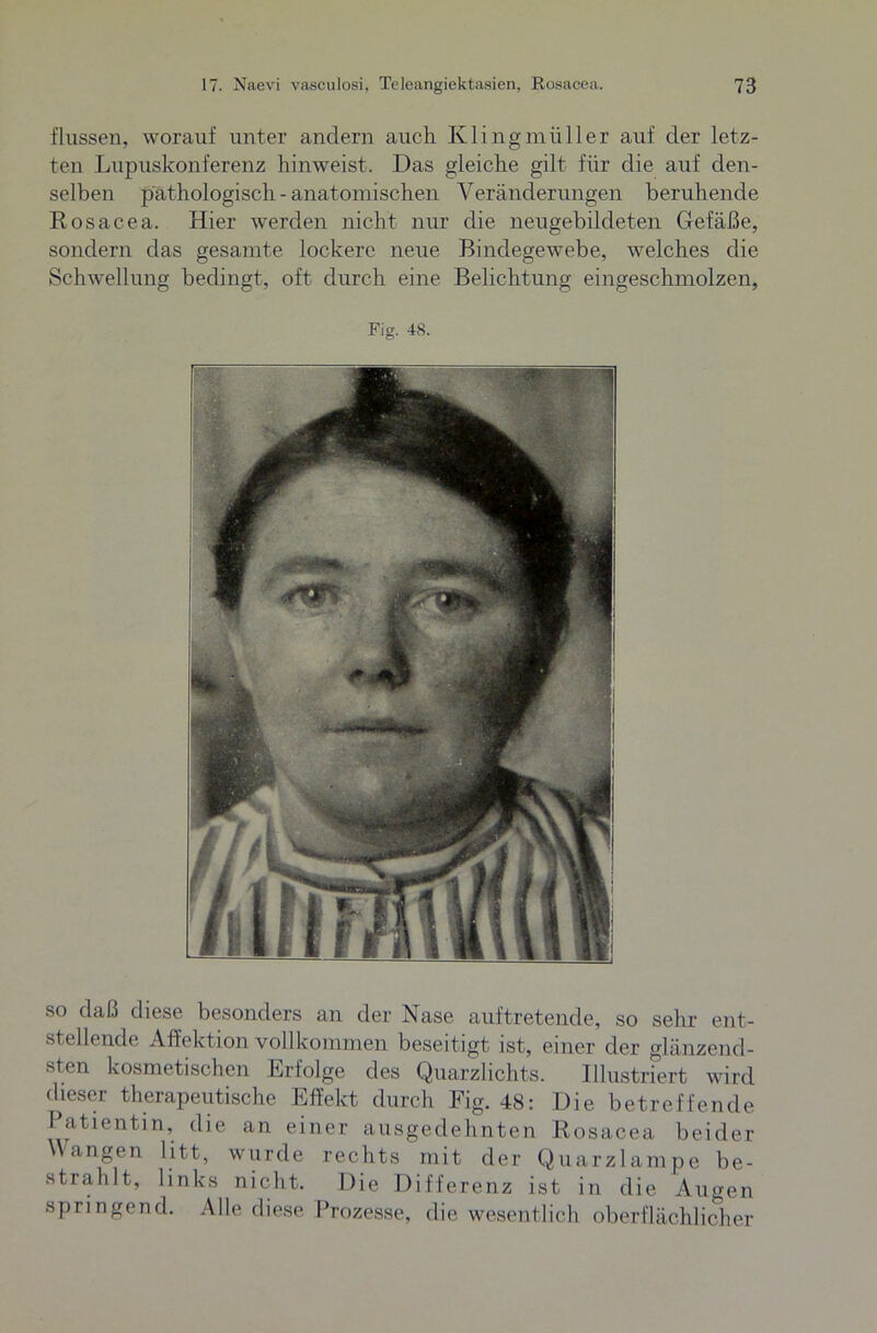 flussen, worauf unter andern auch Klingmüller auf der letz- ten Lupuskonferenz hinweist. Das gleiche gilt für die auf den- selben pathologisch - anatomischen Veränderungen beruhende Rosacea. Hier werden nicht nur die neugebildeten Gefäße, sondern das gesamte lockere neue Bindegewebe, welches die Schwellung bedingt, oft durch eine Belichtung eingeschmolzen, Fig. 48. so daß diese besonders an der Nase auftretende, so sehr ent- stellende Affektion vollkommen beseitigt ist, einer der glänzend- sten kosmetischen Erfolge des Quarzlichts. Illustriert wird dieser therapeutische Effekt durch Fig. 48: Die betreffende Patientin, die an einer ausgedehnten Rosacea beider Wangen litt, wurde rechts mit der Quarzlampe be- strahlt, links nicht. Die Differenz ist in die Augen springend. Alle diese Prozesse, die wesentlich oberflächlicher