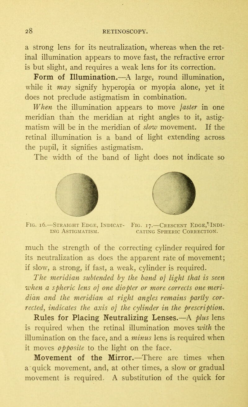 a strong lens for its neutralization, whereas when the ret- inal illumination appears to move fast, the refractive error is but slight, and requires a weak lens for its correction. Form of Illumination.—A large, round illumination, while it may signify hyperopia or myopia alone, yet it does not preclude astigmatism in combination. When the illumination appears to move faster in one meridian than the meridian at right angles to it, astig- matism will be in the meridian of slow movement. If the retinal illumination is a band of light extending across the pupil, it signifies astigmatism. The width of the band of light does not indicate so Fig. 16.—Straight Edge, Indicat- Fig. 17.—Crescent Edge^Indi- ing Astigmatism. cating Spheric Correction. much the strength of the correcting cylinder required for its neutralization as does the apparent rate of movement; if slow, a strong, if fast, a weak, cylinder is required. The meridian subtended by the band of light that is seen when a spheric lens of one diopter or more corrects one meri- dian and the meridian at right angles remains partly cor- rected, indicates the axis of the cylinder in the prescription. Rules for Placing Neutralizing Lenses.—A plus lens is required when the retinal illumination moves with the illumination on the face, and a minus lens is required when it moves opposite to the light on the face. Movement of the Mirror.—There are times when a quick movement, and, at other times, a slow or gradual movement is required. A substitution of the quick for