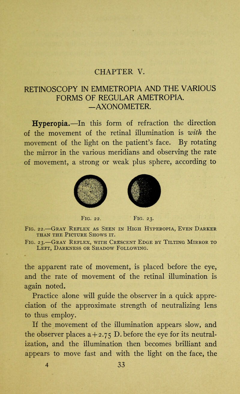 CHAPTER V. RETINOSCOPY IN EMMETROPIA AND THE VARIOUS FORMS OF REGULAR AMETROPIA. -AXONOMETER. Hyperopia.—In this form of refraction the direction of the movement of the retinal illumination is with the movement of the light on the patient’s face. By rotating the mirror in the various meridians and observing the rate of movement, a strong or weak plus sphere, according to Fig. 22. Fig. 23. Fig. 22.—Gray Reflex as Seen in High Hyperopia, Even Darker than the Picture Shows it. Fig. 23.—Gray Reflex, with Crescent Edge by Tilting Mirror to Left, Darkness or Shadow Following. the apparent rate of movement, is placed before the eye, and the rate of movement of the retinal illumination is again noted. Practice alone will guide the observer in a quick appre- ciation of the approximate strength of neutralizing lens to thus employ. If the movement of the illumination appears slow, and the observer places a+ 2.75 D. before the eye for its neutral- ization, and the illumination then becomes brilliant and appears to move fast and with the light on the face, the