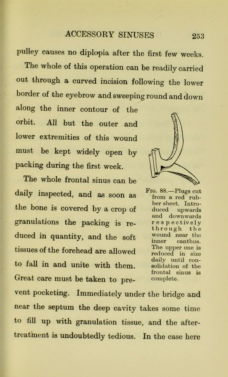 pulley causes no diplopia after the first few weeks. The whole of this operation can be readily carried out through a curved incision following the lower border of the eyebrow and sweeping round and down along the inner contour of the orbit. All but the outer and lower extremities of this wound must be kept widely open by packing during the first week. The whole frontal sinus can be daily inspected, and as soon as the bone is covered by a crop of granulations the packing is re- duced in quantity, and the soft tissues of the forehead are allowed to fall in and unite with them. Great care must be taken to pre- vent pocketing. Immediately under the bridge and near the septum the deep cavity takes some time to fill up with granulation tissue, and the after- treathaent is undoubtedly tedious. In the case here Fig. 88.—Plugs cut from a red rub- ber sheet. Intro- duced upwards and downwards respect ively through the wound near the inner canthus. The upper one is reduced in size daily until con- solidation of the frontal sinus is complete.