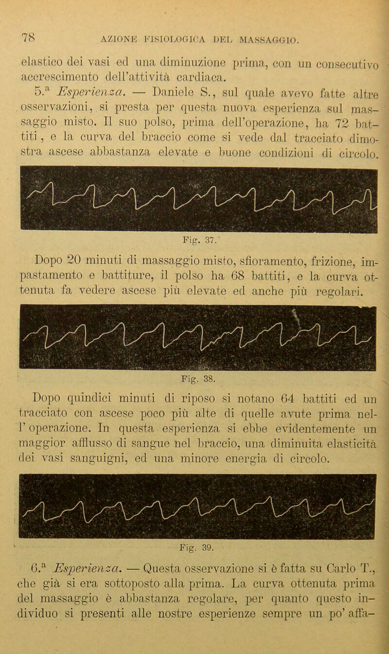 7S oliistico cIgì Vcisi G(l una diniinuzione [ìi'iniji, con un consecutivo accrescimento deH’attività cardiaca. 5.^’' Es-perienza. — Daniele S., sul quale avevo fatte altre osservazioni, si presta per questa nuova esperienza sul mas- saggio misto. Il suo polso, prima deH’operazione, ha 72 bat- titi , e la curva del braccio come si vede dal tracciato dimo- stra ascese abbastanza elevate e buone condizioni di circolo. Fig. 37. Dopo 20 minuti di massaggio misto, sfioramento, frizione, im- pastamento e battiture, il polso ha 68 battiti, e la curva ot- tenuta fa vedere ascese più elevate ed anche più regolari. Fig. 38. Dopo quindici minuti di riposo si notano 04 battiti ed un tracciato con ascese poco più alte di quelle avute prima nel- r operazione. In questa esperienza si ebbe evidentemente un maggior aflìusso di sangue nel tiracelo, una diminuita elasticità dei vasi sanguigni, ed una minore energia di circolo. Fig. 39. G.^ Esperienza. — Questa osservazione si è fatta su Carlo T., che già si era sottoposto alla prima. La curva ottenuta prima del massaggio è abbastanza regolare, per quanto questo in- dividuo si presenti alle nostre esperienze sempre un po’ afta-