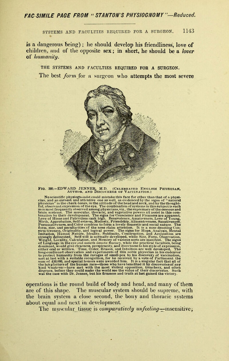 SYSTEMS AND FACULTIES REQUIRED FOR A SURGEON. 1143 is a dangerous being); he should develop his friendliness, love of children, and of the opposite sex; in short, he should be a lover THE SYSTEMS AND FACULTIES REQUIRED FOR A SURGEON. The best form, lor a surgeon who attempts the most severe Fig. 360.—EDWARD JENNER, M.D. (Celebrated English Physician, Author, and Discoverer of Vaccination.) No scientific physiognomist could mistake this face for other than that of a physi- cian, and an earnest and attentive one as well, as evidenced by the signs of “ natural Jihysician” in the cheek-bones, in the attitude of the head and neck, and by the thought- til, observant expression of the eye. The combination of systems in this subject is such as is most f requen tly observed among physicians, viz., the supremacy of the osseous and brain systems. The muscular, thoracic, and vegetative powers all assist in this com- bination by their development. The signs for Conscience and Firmness are apparent. Love of Home and Patriotism rank high. Benevolence, Amativeness, Love of Young, Mirth, Approbation, Self-esteem, Modesty, Friendship, Alimentiveness, Sanativeness Pneumativeness, and Color combine to form a lovely domestic and social nature. The form, size, and peculiarities of the nose claim attention. It is a nose denoting Con- structiveness, Originality, and logical power. The signs for Hope, Analysis, Mental Imitation, Human Nature, Ideality, Sublimity, Construction, and Acquisition are strongly delineated. Self-will is normally developed, while Size, Form, Observation, Weight, Locality, Calculation, and Memory of various sorts are manifest. The signs of Language in the eye and mouth denote fluency, while the practical faculties, being dominant, would give clearness, perspicacity, and directness to his style of expression, either oral or written. Time, Order. Reason, and Intuition are well developed. The long-continued observation and experiments of this noble physician in his endeavor to protect humanity from the ravages of small-pox by his discovery of vaccination, met at last with a suitable recognition, for he received by a vote of Parliament the sum of £30,000, and special honors were awarded him. It is a singular fact that all of the bcVfifactorsof the human race—those who have benefited it by discoveriesof any kind 'Whatever—have met with the most violent opposition, treachery, and often disgrace, before they could make the world see the value of their discoveries. Such was the case with Dr. Jenner, but his firmness and truth at last gained the victory. operations is the round build of body and head, and many of them are of this shape. The muscular system should be supreme, with the brain system a close second, the bony and thoracic systems about equal and next in development The muscular tissue is comparatively unfeeling—insensitive; of humanity.