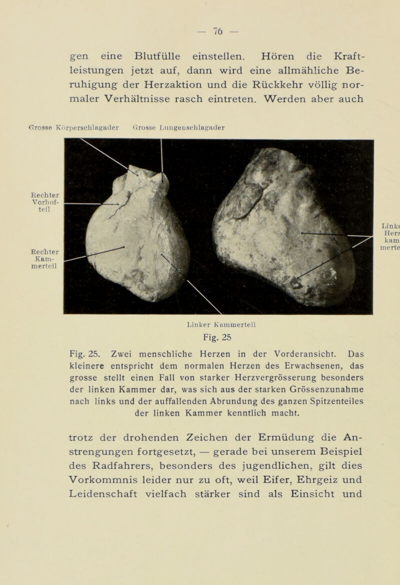 gen eine Blutfülle einstellen. Hören die Kraft- leistungen jetzt auf, dann wird eine allmähliche Be- ruhigung der Herzaktion und die Rückkehr völlig nor- maler Verhältnisse rasch eintreten. Werden aber auch Crosse Körperschlagader Grosse Lungenschlagader Rechter Vorhof- teil Rechter Kam- merteil Linke Herz kam merte Linker Kammerteil Fig. 25 Fig. 25. Zwei menschliche Herzen in der Vorderansicht. Das kleinere entspricht dem normalen Herzen des Erwachsenen, das grosse stellt einen Fall von starker Herzvergrösserung besonders der linken Kammer dar, was sich aus der starken Grössenzunahme nach links und der auffallenden Abrundung des ganzen Spitzenteiles der linken Kammer kenntlich macht. trotz der drohenden Zeichen der Ermüdung die An- strengungen fortgesetzt, — gerade bei unserem Beispiel des Radfahrers, besonders des jugendlichen, gilt dies Vorkommnis leider nur zu oft, weil Eifer, Ehrgeiz und Leidenschaft vielfach stärker sind als Einsicht und