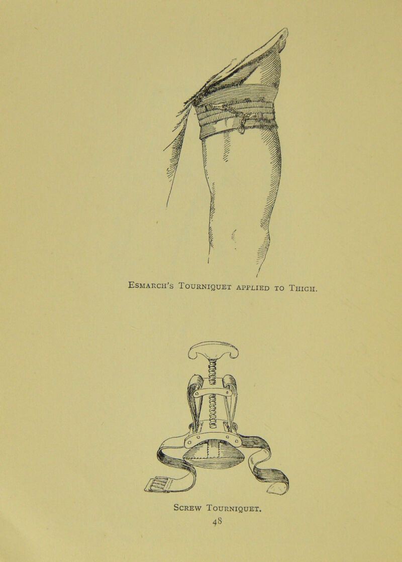 / Esmarch’s Tourniquet applied to Thigh.