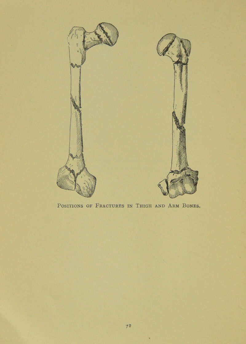 Positions of Fractures in Thigh and Arm Bones. 12