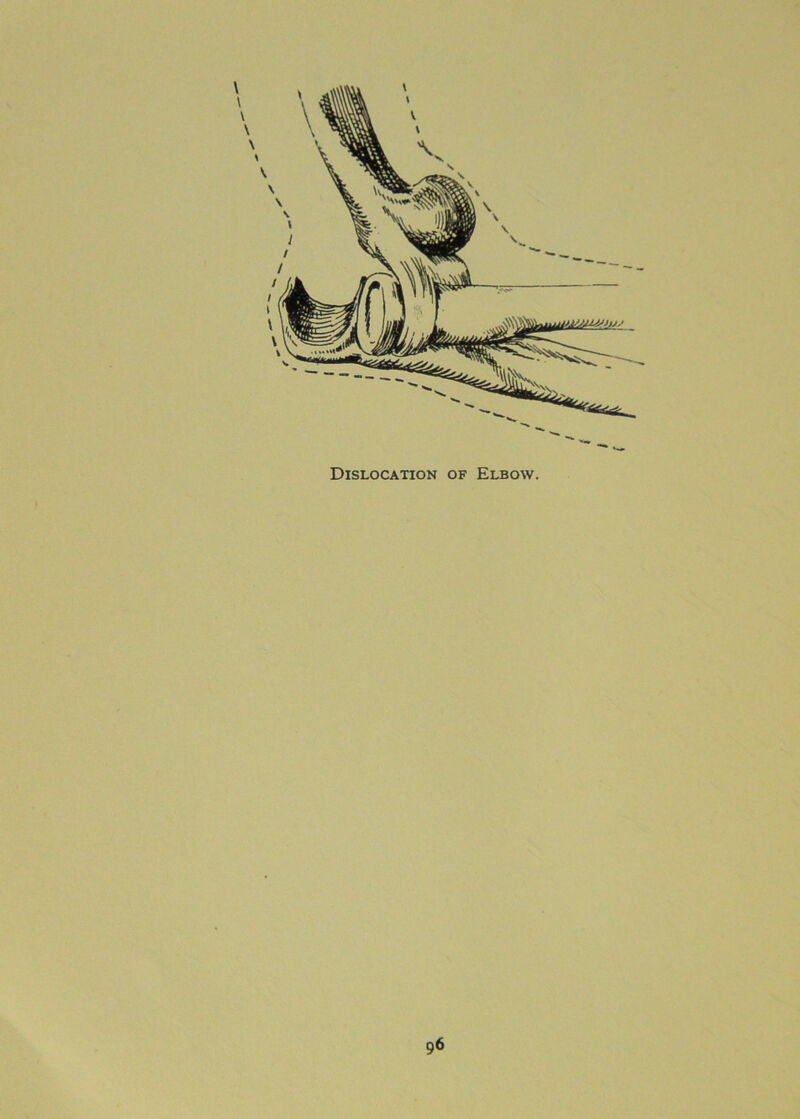 Dislocation of Elbow.