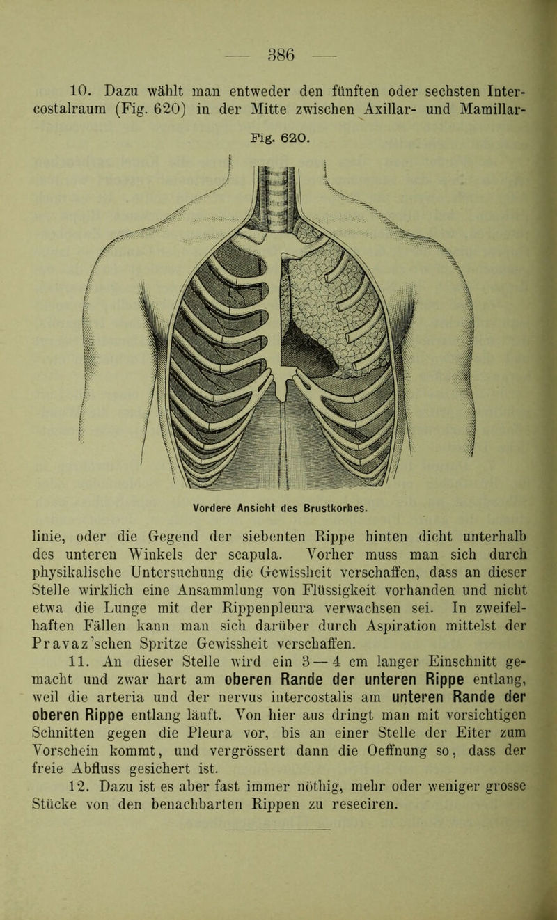 10. Dazu wählt man entweder den fünften oder sechsten Inter- costalraum (Fig. 620) in der Mitte zwischen Axillar- und Maraillar- Fig. 620. Vordere Ansicht des Brustkorbes. linie, oder die Gegend der siebenten Rippe hinten dicht unterhalb des unteren Winkels der scapula. Vorher muss man sich durch physikalische Untersuchung die Gewissheit verschaffen, dass an dieser Stelle wirklich eine Ansammlung von Flüssigkeit vorhanden und nicht etwa die Lunge mit der Rippenpleura verwachsen sei. In zweifel- haften Fällen kann man sich darüber durch Aspiration mittelst der Pravaz’schen Spritze Gewissheit verschaffen. 11. An dieser Stelle wird ein 3—4 cm langer Einschnitt ge- macht und zwar hart am oberen Rande der unteren Rippe entlang, weil die arteria und der nervus iiitercostalis am unteren Rande der oberen Rippe entlang läuft. Von hier aus dringt man mit vorsichtigen Schnitten gegen die Pleura vor, bis an einer Stelle der Eiter zum Vorschein kommt, und vergrössert dann die Oeff'nung so, dass der freie Abfluss gesichert ist. 12. Dazu ist es aber fast immer nöthig, mehr oder weniger grosse Stücke von den benachbarten Rippen zu reseciren.