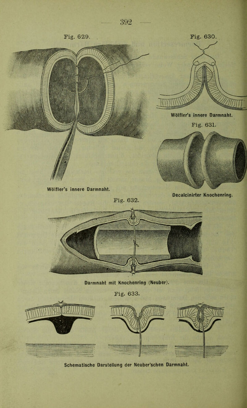 Darmnaht mit Knochenring (Neuber). Fig. 633. Fig. 630. Schematische Darstellung der Neuber’schen Darmnaht.