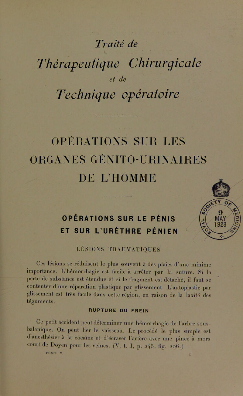 Thérapeiitique Chirurgicale et de Technique opératoire OPÉRATIONS SUR LES ORGANES GÉNITO-URINAIRES DE L’HOMME OPÉRATIONS SUR LE PÉNIS ET SUR L’URÉTHRE PÉNIEN LÉSIONS TRAUMATIQUES Ces lésions se réduisent le jdIus souvent à des plaies d’une minime importance. L’hémorrhagie est facile à arrêter par la suture. Si la perte de substance est étendue èt si le fragment est détaché, il faut se contenter d une réparation plastique par glissement. L’autoplastie par glissement est très facile dans cette région, en raison de la laxité des téguments. RUPTURE DU FREIN Ce petit accident peut déterminer une hémorrhagie de l’arhre sous- halanique. On peut lier le vaisseau. Le procédé le plus simple est d anesthésiei’ a la cocaïne et d’écraser l’artère avec une pince à mors court de Doyen pour les veines. (V. t. 1, p. 2/|5, fig. 20G.) TOME V.