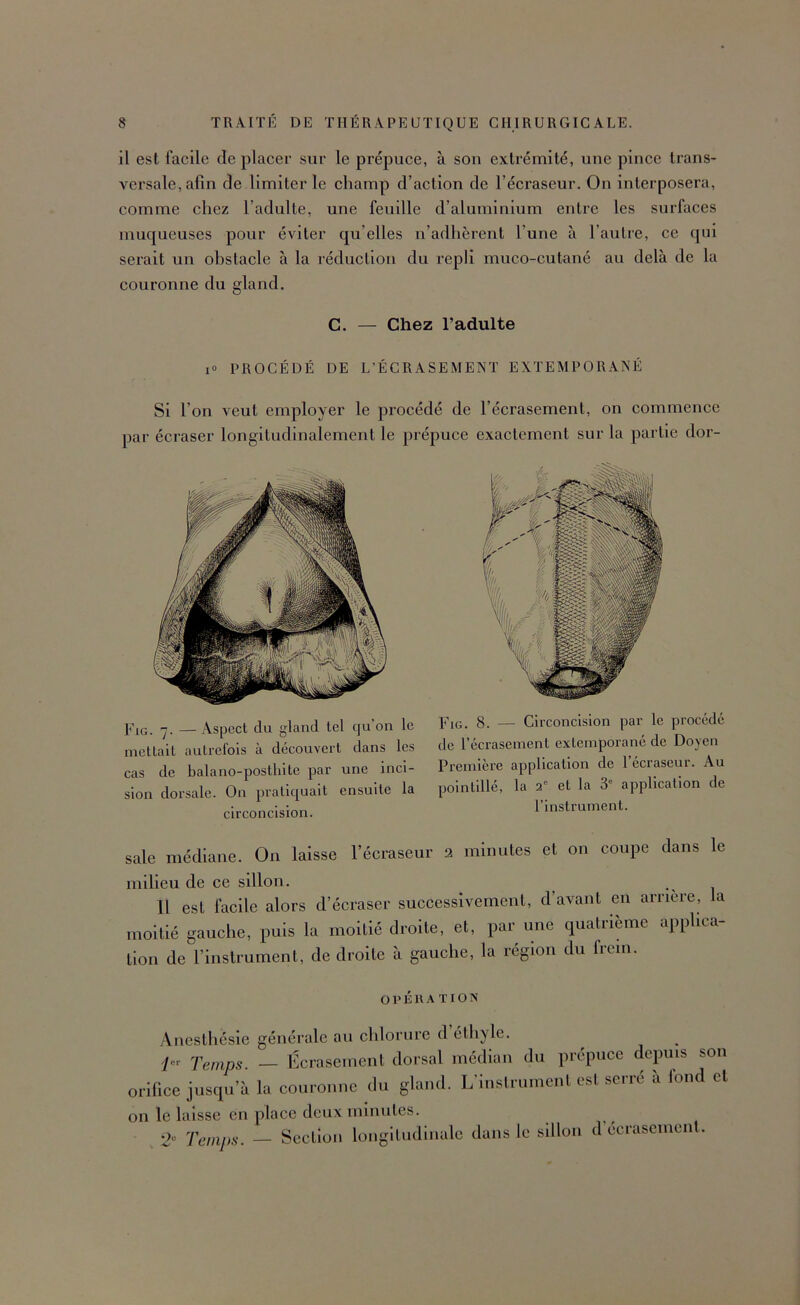 il est iacile de placer sur le prépuce, à son extrémité, une pince trans- versale, afin de limiter le champ d’action de l’écraseur. On interposera, comme chez l’adulte, une feuille d’aluminium entre les surfaces muqueuses pour éviter qu’elles n’adhèrent l’une à l’autre, ce qui serait un obstacle à la réduction du repli muco-cutané au delà de la couronne du gland. C. — Chez l’adulte lO PROCÉDÉ DE L’ÉCRASEMENT EXTEMPORANÉ Si l’on veut employer le procédé de l’écrasement, on commence par écraser longitudinalement le prépuce exactement sur la partie dor- Fig. 7. — Aspect du gland tel qu’on le mettait autrefois à découvert dans les cas de balano-postliite par une inci- sion dorsale. On pratiquait ensuite la circoncision. sale médiane. On laisse 1 ecraseur milieu de ce sillon. Fig. 8. — Circoncision par le procédé de l’écrasement extemporané de Doyen Première application de l’écraseur. Au pointillé, la 2' et la 3” application de l’instrument. 2 minutes et on coupe dans le Il est facile alors d’écraser successivement, d’avant en arrière, la oitié gauche, puis la moitié droite, et, par une quaU’ième apphea- .11 de l’instrument, de droite à gauche, la région du Irein. OPKllA TIOIS Anesthésie générale au chlorure d éthyle. Temps. — Écrasement dorsal médian du prépuce depuis son orifice jusqu’à la couronne du gland. L’instrument est serré à lond cl on le laisse en place deux minutes. Oc Temps. — Section longitudinale dans le sillon d’écrasement.