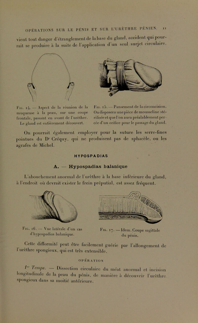 vient tout danger d’étranglement de la base du gland, aecident qui pour- rait se produire à la suite de l’application d’un seul surjet circulaire. Fig. i4- — Aspect de la réunion de la muqueuse à la peau, sur une coupe frontale, passant en avant de l’urèthre. Le gland est entièrement découvert. Fig. 15. — Pansement de la circoncision. On disposera une pièce de mousseline sté- rilisée et que l’on aura préalablement per- cée d’un orifice pour le passage du gland. On pourrait également employer pour la suture les serre-fines pointues du D'' Gréquy, qui ne produisent pas de sphacèle, ou les agrafes de Michel. HYPOSPADIAS A. — Hypospadias balanique a L’abouchement anormal de l’urèthre à la base inférieure du gland, endroit où devrait exister le frein préputial, est assez fréquent. Fig. i6. — Vue latérale d’un cas d’iiypospadias balanique. Fig. l'j. —Idem. Coupe sagittale du pénis. Cette dilforrnité peut être facilement guérie par l’allongement de l’urèthre spongieux, qui est très extensible. O P É n A TIO N Jeinps. — Dissection circulaire longitudinale de la peau du pénis, de spongieux dans sa moitié antérieure. du méat anormal cl incision manière à découvrir l’urèthre