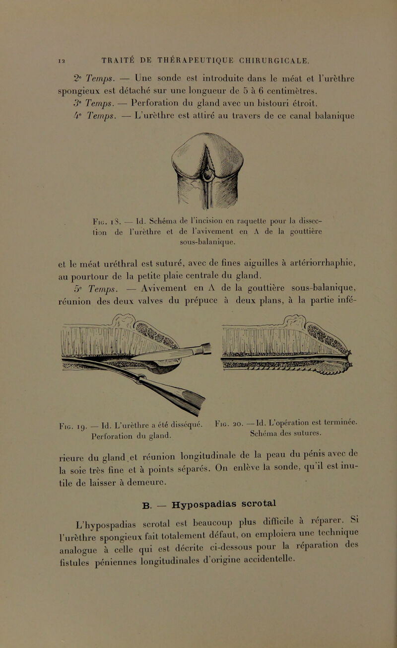 2® Temps. — Une sonde est introduite dans le méat et rurcthre spongieux, est détaché sur une longueur de 5 à G centimètres. iV® Temps. — Perforation du gland avec un bistouri étroit. 4® Temps. — L’urètlire est attiré au travers de ce canal halanique Fig. iS. — Id. Schéma de l’incision en rac]uellc pour la dissec- tion de rurcthre et de l’avivement en A de la gouttière sous-balanicjuc. et le méat uréthral est suturé, avec de fines aiguilles à artériorrhaphie, au pourtour de la petite plaie centrale du gland. 5® Temps. — Avivement en A de la gouttière sous-balanique, réunion des deux valves du prépuce à deux plans, à la partie infé- Fig. 19. — Id. L’urèthre a été disséqué. Perforation du gland. Fig. 20. —Id. L’opération est terminée. Schéma des sutures. rieure du gland.et réunion longitudinale de la peau du pénis avec de la soie très fine et à points séparés. On enlève la sonde, qu il est mu- tile de laisser à demeure. B. — Hypospadias scrotal L’hypospadias scrotal est beaucoup plus difficile à réparer. Si l’urèthre spongieux fait totalement défaut, on emploiera une tcclinique analogue à celle qui est décrite ci-dessous pour la réparation des fistules pénlennes longitudinales d’origine accidentelle.