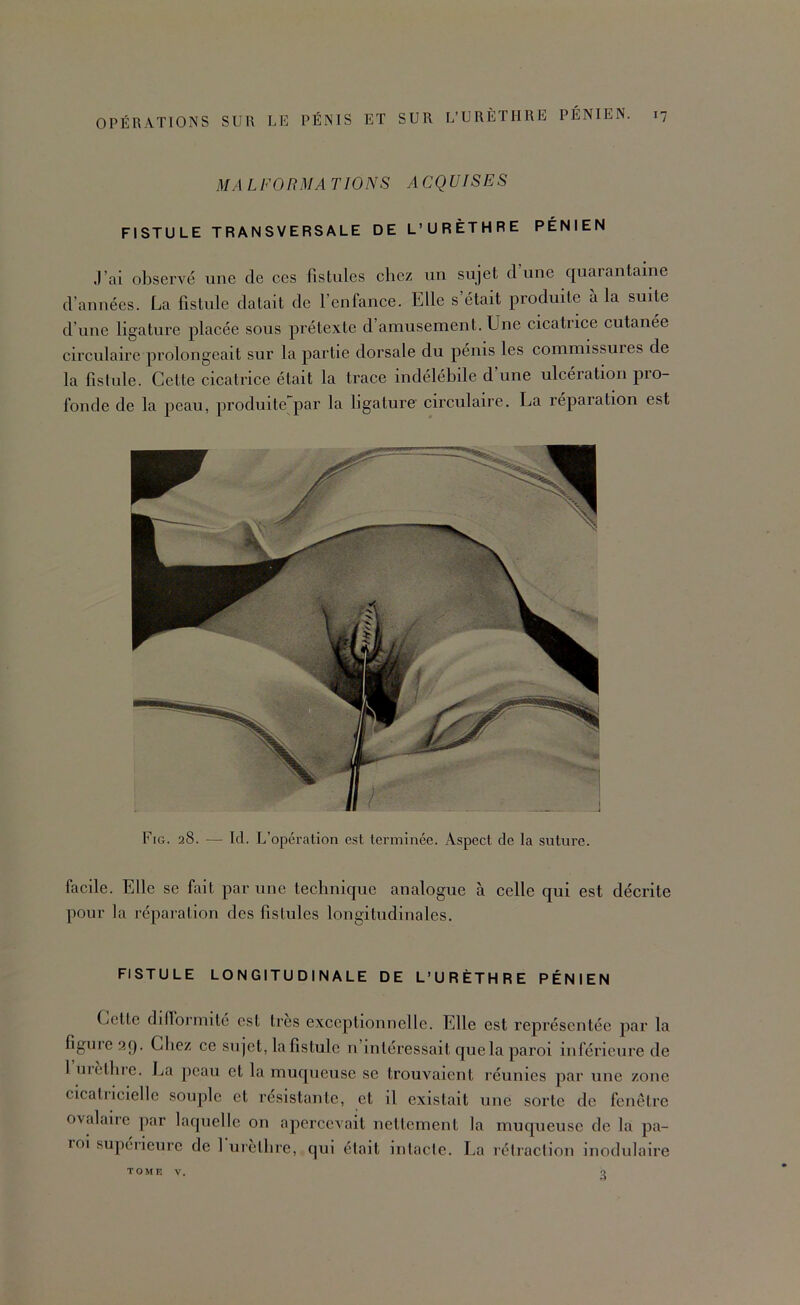 MA LFORMA T IONS ACQUISES FISTULE TRANSVERSALE DE L’URÈTHRE PÉNIEN .l’ai observé une de ces fistules chez un sujet dune quarantaine d’années. La fistule datait de l’enfance. Elle s’était produite à la suite d’une ligature placée sous prétexte d’amusement. Une cicatrice cutanée circulaire prolongeait sur la partie dorsale du pénis les commissures de la fistule. Cette cicatrice était la trace indélébile d’une ulcération pro- fonde de la peau, produite par la ligature circulaire. La réparation est Fig. 28. — Id. L’opération est terminée. Aspect de la suture. facile. Elle se fait par une technique analogue à celle qui est décrite pour la réparation des fistules longitudinales. FISTULE LONGITUDINALE DE L’URÈTHRE PÉNIEN Cette ddlbrmité est très exceptionnelle. Elle est représentée par la figure 99. Chez ce sujet, la fistule n’intéressait que la paroi inférieure de l uietbre. La peau et la muqueuse se trouvaient réunies par une zone cicatnciellc souple et résistante, et il existait une sorte de fenêtre ovalaire par laquelle on apercevait nettement la muqueuse de la pa- roi supérieui’C de 1 uietbre, qui était intacte. La réiraclion inodulaire TOMK V, 3