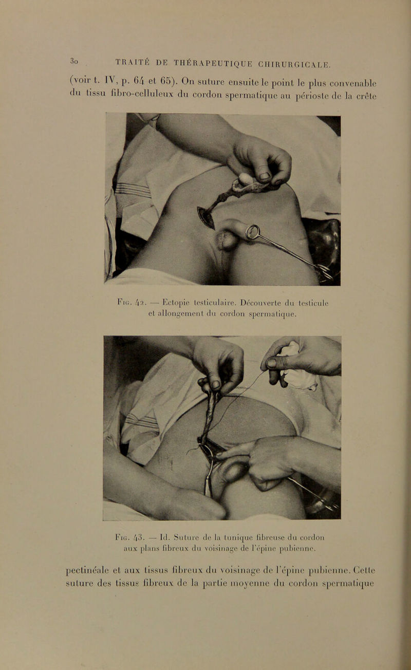 (\oir t. IV, p. 6/| el 65). On suture ensuite le point le plus convenable (In tissu fibro-cclluleux du cordon spermatique au jiériostc de la crete Fig. [\2. — Eclopie Icsiiculairc. Découverte du Lesliculc cl allongemciil du cordon spcrmalique. Fig. t\'à. — Itl. SuLure de la luuiquc fibreuse du cordon aux plans fibreux du voisinage de l’épiiie pubienne. pectinéale et aux tissus fibreux du voisinage de r('|nne pubienne. Celle suture des tissus fibreux de la partie moyenne du cordon spcrmalique