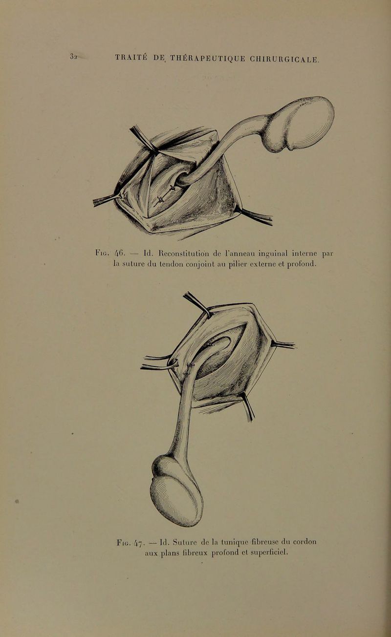 — tel. Rcconslilulion de l’anneau inguinal inlerne la suture du tendon conjoint au pilier externe et profond. Fig. 47- — 1<1- Suinre do la Innique fdn'cuse du cordon aux plans lilereux profond cl supcrlicicl.