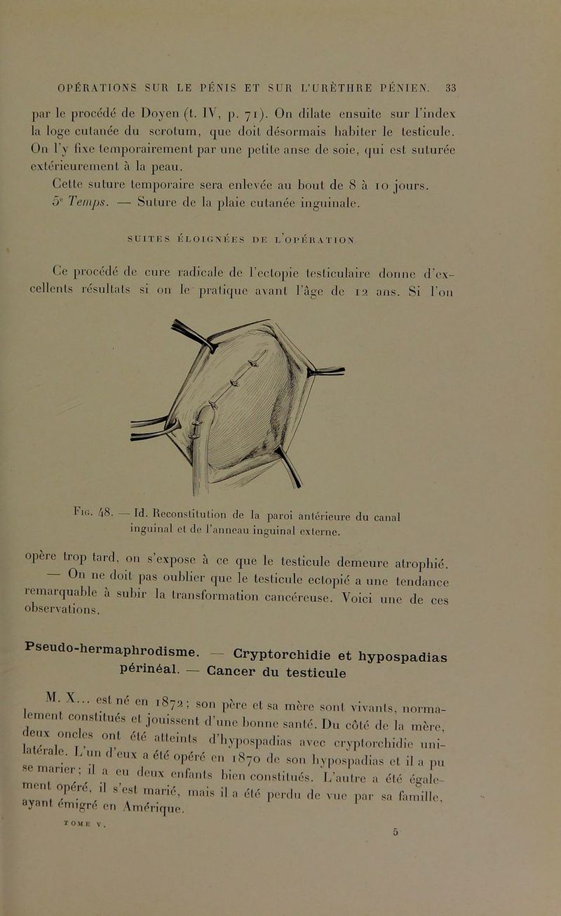 par le procédé de Doyen (t. IV , p. 71). On dilate ensuite siii' l’index la loge cutanée du scrotum, que doit désormais liahiter le testicule. On l’y fixe temijorairement ^^ar une petite anse de soie, (pii est suturée extérieurement à la peau. Cette suture temporaire sera enlovée au bout de 8 à 10 jours. ü Temps. — Suture de la plaie eutanée inguinale. SUITES ÉLOKINÉES DE l’opÉRATIOX Ce procédé de cure radicale de l’ectopie testiculaire donne d’ex- cellents lésultats si on le pralique avant l’âge de 12 ans. Si l’on CiG. 48. Id. Reconslitulion de la paroi antérieure du canal inguinal et de l’anneau inguinal ex terne. opéré trop tard, on s’expose à ee que le testieule demeure atrophié. On ne doit pas oublier que le testicule ectopié aune lendanee remarquable a subir la transformation cancéreuse. Voici une de ces observations. Pseudo-hermaphrodisme. — Cryptorchidie et hypospadias périnéal. — Cancer du testicule M. X... (îst ne en 1872 ; son pi'n-c et sa mère sont vivants, norma- ement constitués et jouissent d’une bonne santé. Du côté de la mère, T-' d’bypospadias avec cryptorcbidic nni- a eia c. . n,i d eux a été opéré en 1870 de .son bypospadias et il a pu maiiei 1 a en deux eid’ants bien constitués, l/autre a été égab'- ^ marié, mais d a été perdu de vue par .sa famille, ayant émigré en Amérique. T O M 1; V . 5