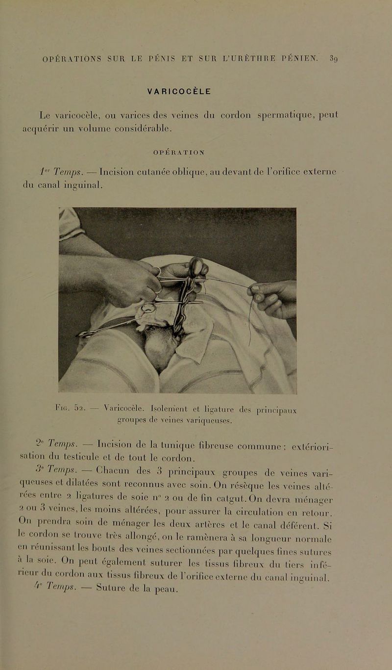 VARICOCÈLE Le vaiieocèlc, on varices des veines du cordon spermatique, peut ac(piérir un volume considérable. OPÉRATION /'”■ Temps. — Incision cutanée oblique, au devant de ronfice externe du canal inguinal. l'io. 5a. — Varicocèle. IsolemenL et ligature clc.s principau.x groupes de veines varic[ueuses. 2 Temps. — Incision de la tunique librcuse commune: exlériori- sation du testicule et de tout le cordon. Temps. — Cbacnn des 3 principaux groupes de veines vari- (pieuscs et dilatées sont reconnus avec soin. Ou résèque les veines allé- rées entre 9. ligatures de soie n 2 ou de Un catgut. On devra ménager 2011 .) veines, les moins altérées, pour assurer la circulalion en retour. On prendra soin de ménager les deux artères et le canal déférent. Si le cordon se Ironve tn's allongé, on le ramènera à sa longueur normale en réunissant les bouts des veines .sectionnées paripiclqnes fines .suinres à la soie. On peut également suturer les tissus libreux du tiers infé- rieur du cordon aux tissus libreux de l’orilicc externe du canal inguinal. / lemps. — bntnrc de la peau.