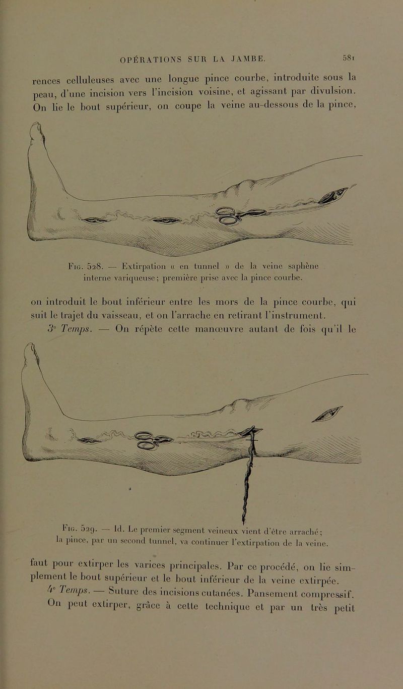rcnces celluleuses avec une longue pince courl)e, introduite sous la peau, d’une incision vers l’incision voisine, et agissant par divulsion. On lie le bout supérieur, on eoupe la veine au-dessous de la pince. Fig. 628. — Exlirpaliou « en tunnel » de la Yeinc saphène interne varicjueuse; première prise avec la pince courbe. l'iG. 029. 1(1. Le premier segment veineux vient d’ètre arraché; a pince, par un second tunnel, va continuer l’extirpation de la veine. on introduit le bout inférieur entre les mors de la pince courbe, qui suit le trajet du vaisseau, et on l’arrache en retirant l’instrument. 5“ Temps. — On répète cette manœuvre autant de fois qu’il le faut pour extirper les varices [uincipales. Par ce procédé, on lie sim- plement le bout supérieur et le bout inférieur de la veine extirpée. 4” 1 einps. Snture des incisions cutanées. Pansement compressif. On peut extirper, grâce à cette technique et par un très petit