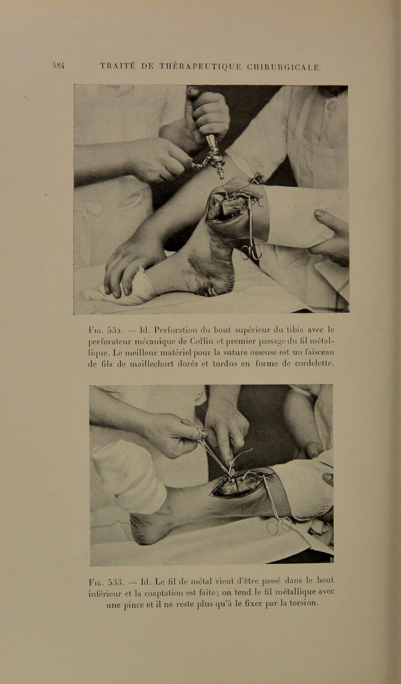 ri84 TRAITI?. DE TTlÉn Al’EUTlQUE G 11 I U U l\ T. IC A 1,E. Fig. 532. — Tel. Pcrl'oralion du bout supérieur du tibia avec le perforateur me'canic|ue de Colliu et premier passage du lil métal- licjue. I_,e meilleur matériel pour la suture osseuse est uu faisceau de fils de maillechort dorés et tordus en forme de cordelette. Fig. 533. — Id. Le fil de métal vient d’ètrc passé dans le bout inférieur et la coaptation est faite; on tend le lil métallique avec une pince et il ne reste plus qu’à le fixer par la torsion.