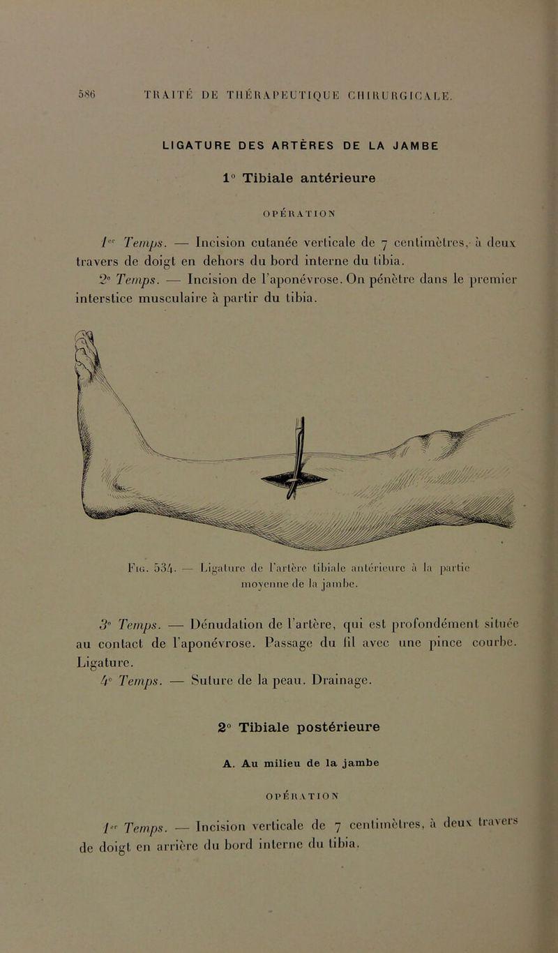 LIGATURE DES ARTERES DE LA JAMBE 1° Tibiale antérieure O P É U A r IO N /”'■ Temps. — Incision cutanée verticale de 7 centimètres, à deuv travers de doigt en dehors du bord interne du tibia. 2“ Temps. — Incision de l’aponévrose. On pénètre dans le premier interstice musculaire à partir du tibia. Fiü. 53/1. - Ligaliifc (le l’arlcrc libialc aiilc’rieurc à la moyenne de la jamhe. partie 5” Temps. — Dénudation de l’artère, qui est profondément située au contact de l’aponévrose. Passage du lit avec une pince courbe. Ligature. 4“ Temps. — Suture de la peau. Drainage. 2° Tibiale postérieure A. Au milieu de la jambe OPÉKVXrON Temps. — Incision verticale de 7 cenlimètres, à deux travers de doigt en arrière du bord interne du tibia.