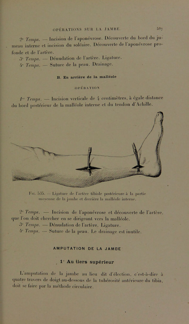 01> K HATIONS SDH LA JAMBE. 687 •> Temps. Incision de l'aponévrose. Découverte du bord du ju- meau intei'iic cl incision du solcaire. Decouveile de 1 aponé^lOse pio- f'onde et de l’aiTcre. ,V“ Temps. — Dénudation de l’artère. Ligalure. Temps. — Suture de la peau. Drainage. B. En arrière de la malléole Ol’KIlA T ION T'' Temps. — Incision verticale de [\ centimètres, a égale distance du bord postérieur de la malléole interne et du tendon d Acbille. I*èn. 535. — Ligalure cio rartèro tibiale postérieure à la jiarlie inoyeuue de la jambe el derrière la inallc'îole interne. Temps. — Incision de l’aponévrose et découverte de l’artère, que l’on doit cbercher en se dirigeant vers la malléole. .V Temps. — Dénudation de l’artère. Ligature. T leinps. — Suture delà peau. Le drainage est inutile. AMPUTATION DE LA JAMDE 1 Au tiers supérieur L am|)iitalioii dc' la jamlie an lien dit d’élccllon, c'est-à-dire à cpiatre travers dc doigt au-dessous de la lubérosilé antérieure du tibia, doil se laire par la niélbode circulaire.