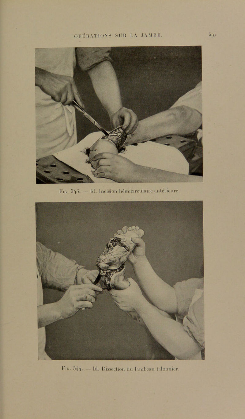 Fig. 5^|3. — Id. Incision hcniicircnlnirc anlcricnro. l'iG. 5/1^1. — Itl. Dissection (,ln lainbcan lalonnlcr.