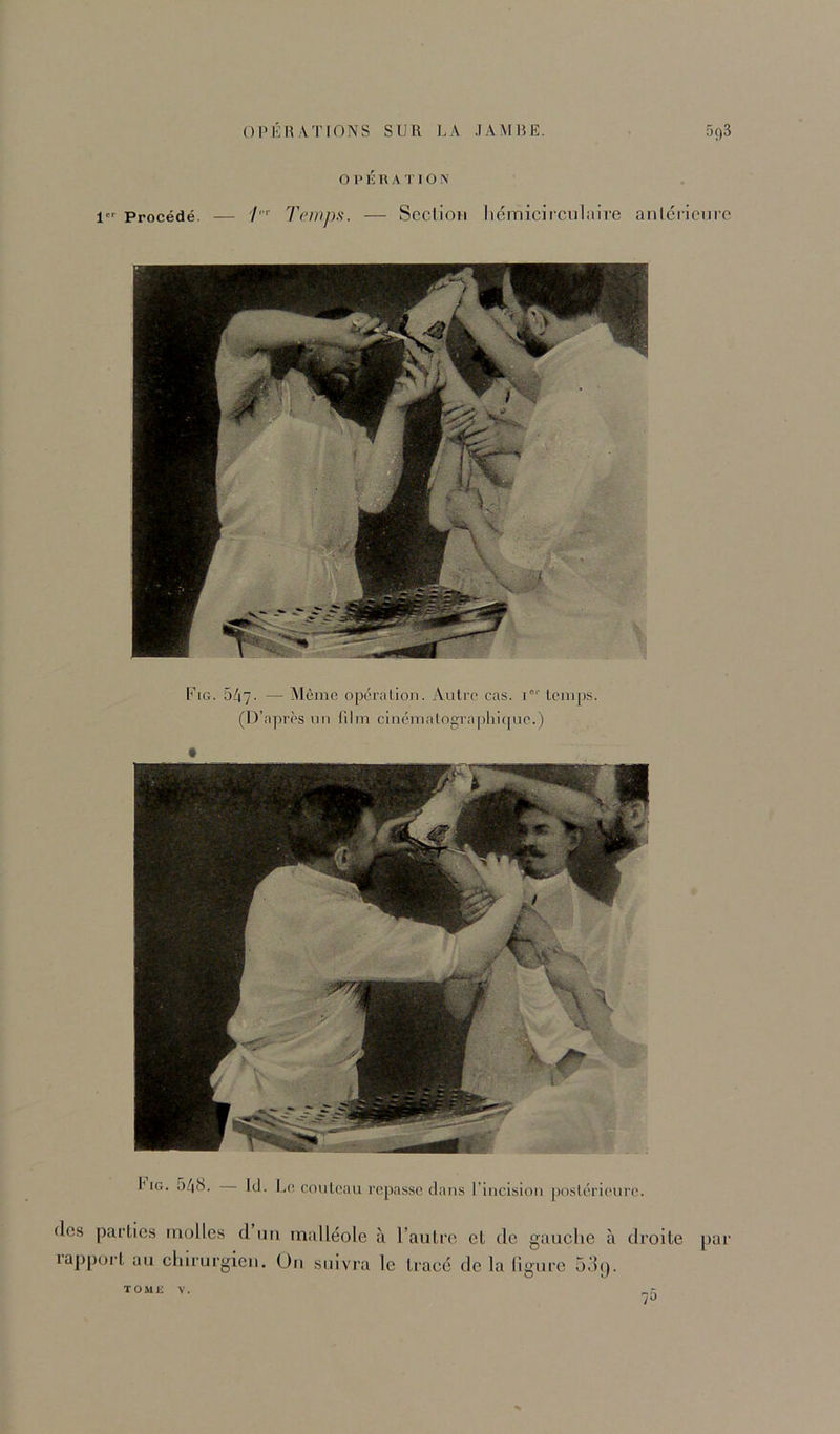 O P K U A I’ I O N 1 Procédé. — Temps. ScclioM liomicirculaire anicriciirc F[g. 547. ■— Alème opéralion. Autre cas. i°‘'temps. (D’apres un film cinématographicpie.) Iog. 548. Id. 1.1e couteau repasse dans l’incision poslérieure. (les parties molles d uii malléole à l’autre et de gauelie à droite par lapport au eliirurgien. Ou suivra le traec de la ligure 53().