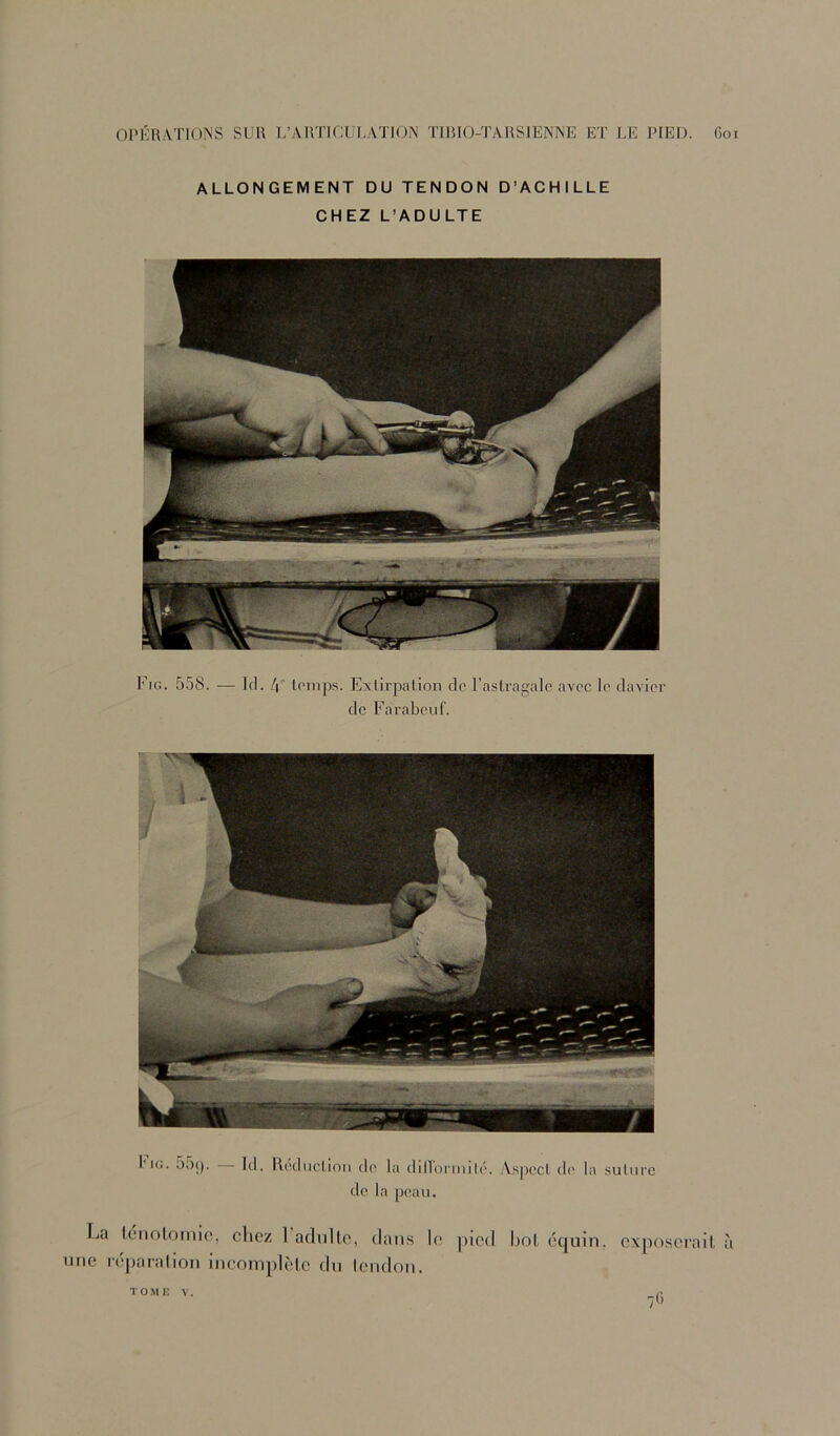 ALLONGEMENT DU TENDON D’ACHILLE CHEZ L’ADULTE Fig. 558. — ](1. [\ temps. Extirpation do l’astragale avec le clavier de Farabeiif. I’*G. 55(). Id. Réduction de la dillorniilé. Aspect de la suture de la peau. La lénolfjinio, cliez 1 adnllo, dans Ic^ jilcd Roi équin, exposerait, à une réparation incomplèle dn tendon. TOME V. /b