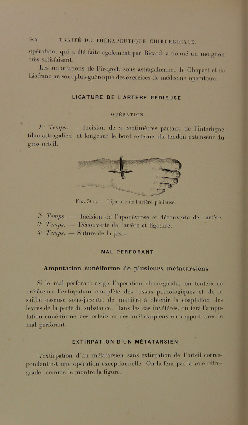 très satislaisant. Les amputations de PirogolT', sous-astragalienne, de Cliopart et de Lislranc ne sont plus guère que des exereiees de médeeine opératoire. LIGATURE DE L’ARTÈRE PÉDIEUSE O P É U A ï 1 O N / Temps. — Ineision de a centimètres partant de l’interligne tibio-astragalien, et longeant le bord externe du tendon extenseur du gros orteil. Fig. 5Go. Ligature de l’arlèrc pédieuse. Oc 3° lemps. — Incision de l’aponévrose et découverte de l’artère. Temps. — Découverte de l’artère et ligature. Temps. — Suture de la peau. MAL PERFORANT Amputation cunéiforme de plusieurs métatarsiens Si le mal perforant exige l’opération chirurgicale, on tentera de préférence l’extirpation complète des tissus pathologiques et de la saillie osseuse sous-jacente, de manière à obtenir la coaptation des lèvres de la perte de substance. Dans les cas invétérés, on fera l’ampu- tation cunéiforme des orteils et des métacarpiens en rapport avec le mal perforant. EXTIRPATION D’UN MÉTATARSIEN Ij’cxtirpation d’un métatarsien sans extirpation de l’orteil corres- pondant est une opération exceptionnelle On la fera parla voie rétro- grade, comme le montre la ligure.