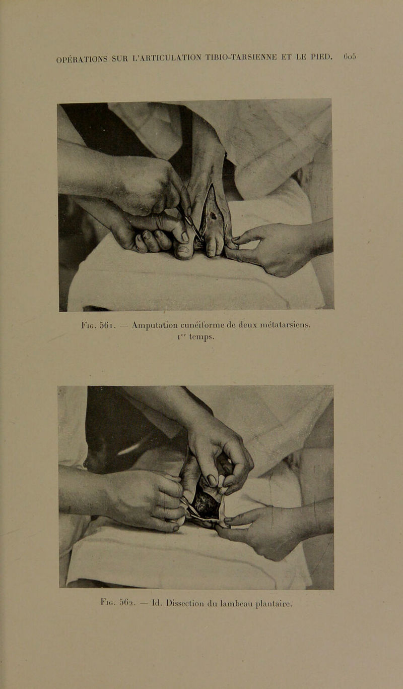 Fig. 561. — Ampulalion cunéilormc do doux molaiarsicns. D'' temps. IO(i. o6a. — lil. Dissoclioii du laïuboau [)lanlairo.