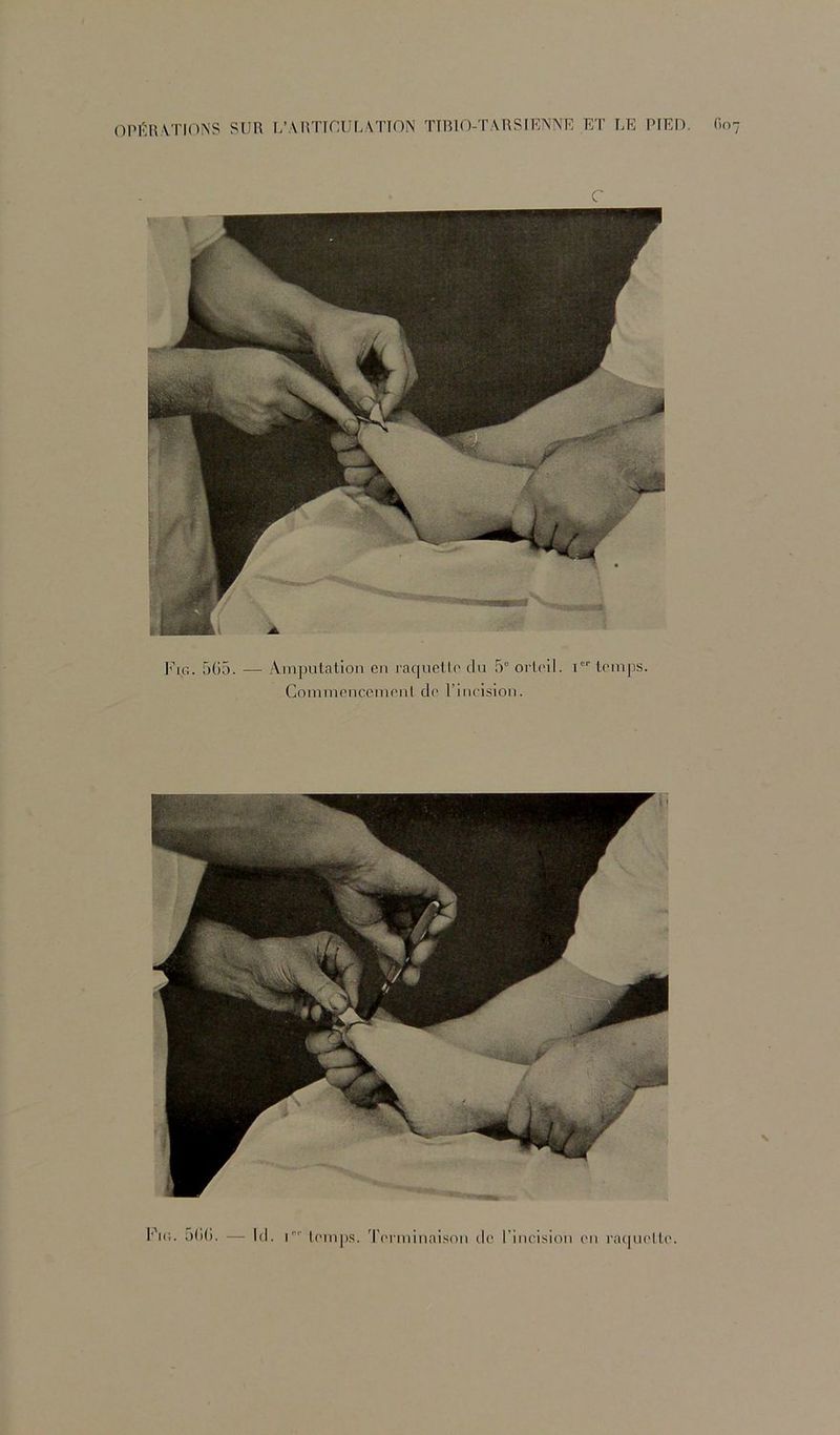 5()5. — Amputation en raquette du 5“ orteil. 1'' tem])S. Commenccinenl de l’ineision.