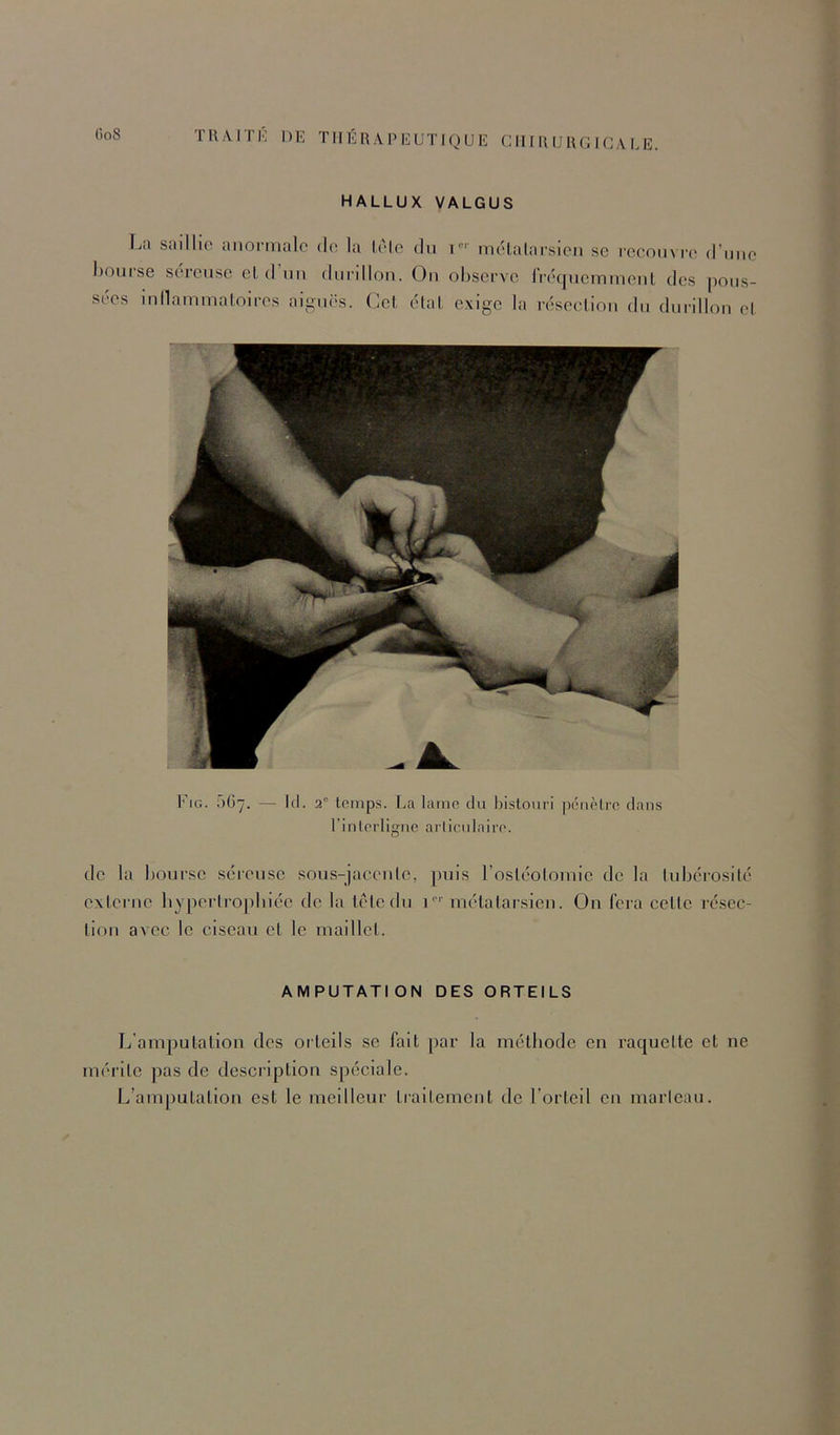 HALLUX VALGUS La saillio anomialc do la lolo du i- mcUalarsien sc rccouvro d’mio houiso scrcuso cl d un dui'dlon. Ou observe Irocjucimucut des pous- sées inllammaloires aiguës. Cel, élaL exige la réseeliou du durillon el Fig. f)()7. — 1(1. 2' t(’mps. La lamo du bistouri pénètre dans l’intt’rligne arlicadairo. de la bourse séreuse sous-jaceule, puis rosléolouiie de la lubérosilé externe bypertro])biée de la tête du i métatarsien. On fera cette résec- tion avec le ciseau et le maillet. AMPUTATION DES ORTEILS L'am]mtation des orteils se fait par la méthode en racpjette et ne mérite pas de description spéciale. L’amputation est le meilleur traitement de l’orteil eu marlcau.