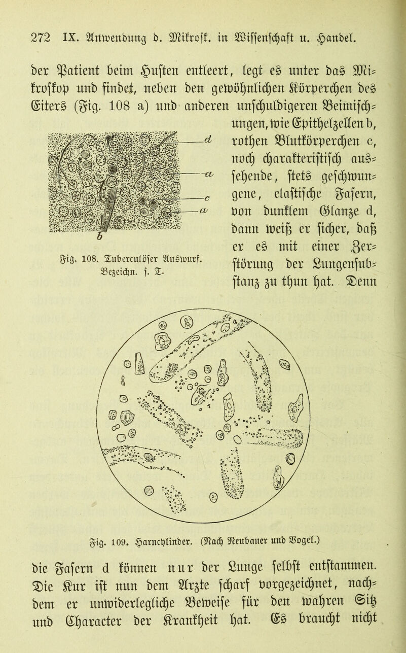 ber Patient beim §uften entleert, legt e§ unter bab ÜDcü froffop unb finbei, neben ben gelüöfjniidjen Iftörperdjen beb ©iterb (gig. 108 a) unb anberen unfdiulbigeren SSeimifcffs ungen, Jnie ©pittjeijeilen b, rotten 33tutförberd)en c, nocfj diarafteriftifd) au§= feljenbe, ftetb gefd)itmn= gene, eiaftifdje gaferti, üon bunfiem (Stfanje d, bann meiff er fic£»er, baß er eb mit einer $er= ftörung ber £ungenfub= ftang ju ttjun tjat. Senn gig. 109. Savtict)(inber. (9Jadj Jieubauer unb Sogei.) bie Wafern d tonnen nur ber Sunge felbft entflammen. Sie ®ur ift nun bem Strjte fctjarf borgejeidinet, nad)* bem er uninibertegtidfe Söetoeife für beit magren ©i| unb ©tjaracter ber ibranftjeit £)at. ©b braucht nic£)t 108. Subercuröfer 2lu§tüurf. 23egeiä)n. f. 5E.