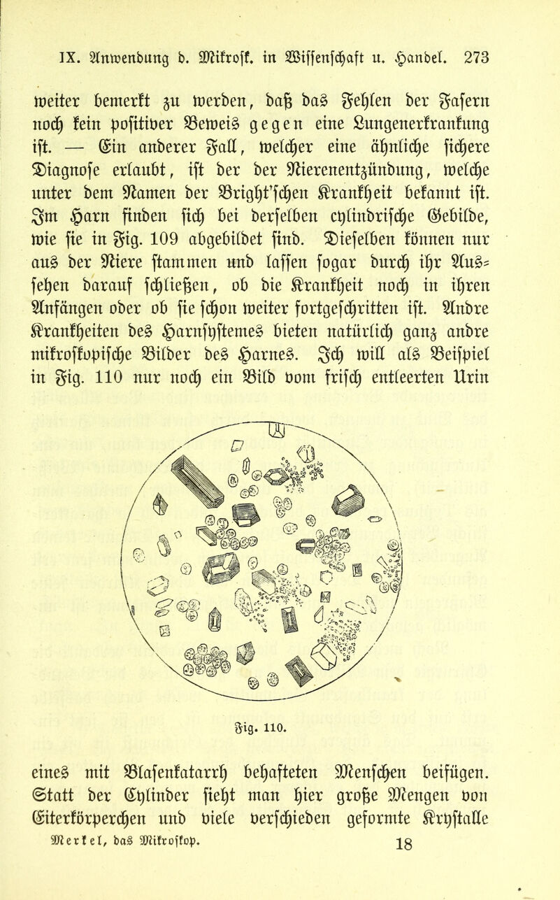 weiter bemerft ju Serben, bafj ba§ gelten ber gafern noä) fein pofitiöer 33emei§ gegen eine Snngenerfranfnng ift. — @in anberer galt, metdjer eine ähntidEje fixere Siagnofe ertanbt, ift ber ber -Jtierenentäünbnng, metctje unter bem tarnen ber SSrigljffcfyen ®ranft)eit befamtt ift. 3>nt «Iparn finben fid^ bei berfetben ct)tinbrifd£)e (S5ebi£bef mie fie in gig. 109 abgebübet finb. Siefetben fönnen nnr au£ ber SXliere ftantmen nnb taffen fogar bnrctj xf)x fefyen baranf fdjtiefsen, ob bie ®ranft)eit noch in ihren Anfängen ober ob fie fdfjon Leiter fortgefdritten ift. Slnbre Sranffjeiten be£ ^>arnft)fteme§ bieten natürlich gan$ anbre mifroffopifche SSitber be£ £)arne£. 3cf) toiH afö SSeifpiet in gig. 110 nnr noch ein SSitb Oont frifcf) entleerten Urin eineg mit 93tafenfatarrf) behafteten SOienfchen beifügen. Statt ber ©ptinber fie£)t man f)kx gro^e Mengen üon (Siterförperchen nnb Diele üerfd£)ieben geformte Srpftaße Wertet, ba§ äfttlroffop. jg
