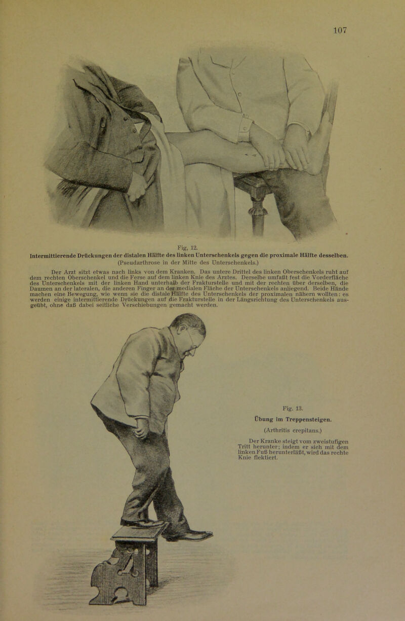 Fig, 12. Intermittierende Drückungen der distalen Hälfte des linken Unterschenkels gegen die pro.xlmale Hälfte desselben. (Pseudarthrose in der Mitte des Unterschenkels.) Der Arzt sitzt etwas nach iinks von dem Kranken. Das untere Drittei des linken Oberschenkels ruht auf dem rechten Oberschenkel und die Ferse auf dem linken Knie des Arztes. Derselbe umfaßt fest die Vorderfläche des Unterschenkels mit der linken Hand unterhalb der Frakturstelle und mit der rechten über derselben, die Daumen an der lateralen, die anderen Finger an derinedialen Fläche der Unterschenkels anliegend. Beide Hände machen eine Bewegung, wie wenn sie die distale Hälfte des Unterschenkels der proximalen näliern wollten: es werden einige intermittierende DrUckungen auf die Frakturstelle in der Längsrichtung des Unterschenkels aus- geUbt, ohne daß dabei seitliche Verschiebungen gemacht werden. Fig. 13. Übung im Treppensteigen. (Arthritis crepitans.) Der Kranke steigt vom zweistufigen Tritt herunter; indem er sich mit dem linken Fuß herunterläßt, wird das rechte Knie flektiert.