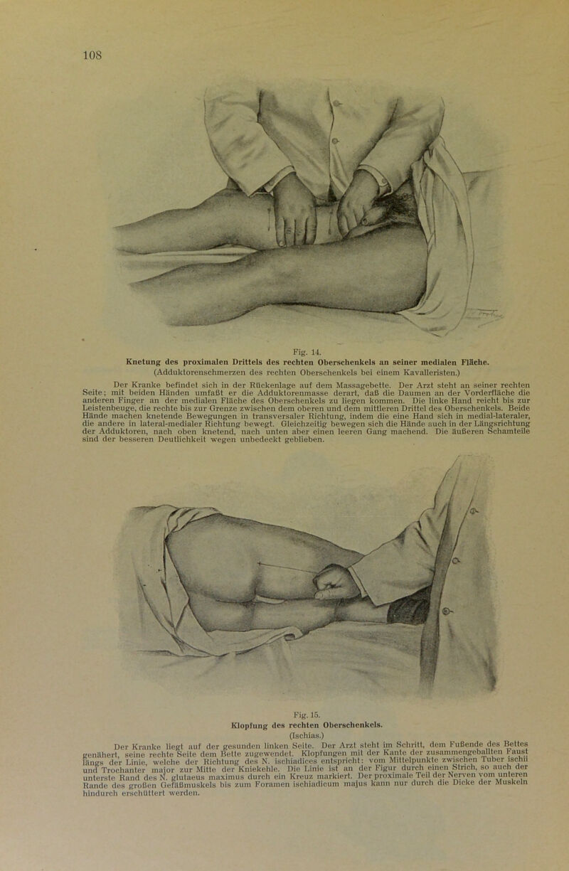 lOS Fig. 14. Knetung des pro.ximalen Drittels des rechten Oberschenkels an seiner medialen Fläche. (Adduktorenschmerzen des rechten Oberschenkels bei einem Kavalleristen.) Der Kranke befindet sich in der Rückenlage auf dem Massagebetle. Der Arzt steht an seiner rechten Seite; mit beiden Händen umfaßt er die Adduktorenmasse derart, daß die Daumen an der Vorderfläche die anderen Finger an der medialen Fläche des Oberschenkels zu liegen kommen. Die linke Hand reicht bis zur Leistenbeuge, die rechte bis zur Grenze zwischen dem oberen und dem mittleren Drittel des Oberschenkels. Beide Hände machen knetende Bewegungen in transversaler Richtung, indem die eine Hand sich in medial-lateraler, die andere in lateral-medialer iSchtung bewegt. Gleichzeitig bewegen sich die Hände auch in der Längsrichtung der Adduktoren, nach oben knetend, nach unten aber einen leeren Gang machend. Die äußeren Schamteile sind der besseren Deutlichkeit wegen unbedeckt geblieben. Fig. 15. Klopfung des rechten Oberschenkels. (Ischias.) Der Kranke liegt auf der gesunden linken Seite. Der Arzt steht im Schritt, dem Fußende des Bettes genähert, seine rechte Seite dem Bette zugewendet. Klopfungen mit der Kante der zusammengeballten raust längs der Linie, welche der Richtung des N. ischiadices entspricht: vom Mittelpunkte zwischen Tuber ischn und Trochanter maior zur Mitte der Kniekehle. Die Linie ist an der Figur durch einen Strich, so auch der unterste Rand des N. glutaeus maximus durch ein Kreuz markiert. Der proximale Teil der Nerven vom unteren Rande des großen Gefäßmuskels bis zum Foramen ischiadicum majus kann nur durch die Dicke der Muskeln hindurch erschüttert werden.