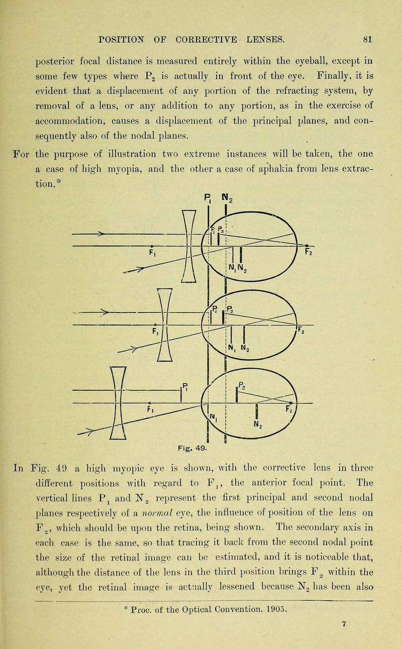posterior focal distance is measured entirely within the eyeball, except in some few types where P2 is actually in front of the eye. Finally, it is evident that a displacement of any portion of the refracting system, by removal of a lens, or any addition to any portion, as in the exercise of accommodation, causes a displacement of the principal planes, and con- sequently also of the nodal planes. For the purpose of illustration two extreme instances will be taken, the one a case of high myopia, and the other a case of aphakia from lens extrac- tion/ In Fig. 49 a high myopic eye is shown, with the corrective lens in three different positions with regard to F }, the anterior focal point. The vertical lines P and N2 represent the first principal and second nodal planes respectively of a normal eye, the influence of position of the lens on F3, which should be upon the retina, being shown. The secondary axis in each case is the same, so that tracing it back from the second nodal point the size of the. retinal image can be estimated, and it is noticeable that, although the distance of the lens in the third position brings F2 within the eye, yet the retinal image is actually lessened because N2 has been also * Proc. of the Optical Convention. 1905. 7