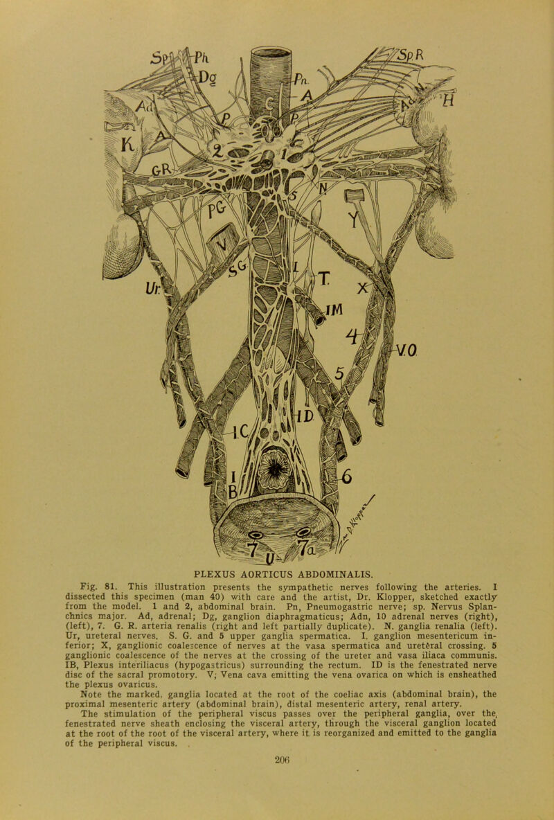 PLEXUS AORTICUS ABDOMINALIS. Fig. 81. This illustration presents the sympathetic nerves following the arteries. I dissected this specimen (man 40) with care and the artist, Dr. Klopper, sketched exactly from the model. 1 and 2, abdominal brain. Pn, Pneumogastric nerve; sp. Nervus Splan- chnics major. Ad, adrenal; Dg, ganglion diaphragmaticus; Adn, 10 adrenal nerves (right), (left), 7. G. R. arteria renalis (right and left partially duplicate). N. ganglia renalia (left). Ur, ureteral nerves. S. G. and 5 upper ganglia spermatica. I. ganglion mesentericum in- ferior; X, ganglionic coalescence of nerves at the vasa spermatica and uretferal crossing. 5 ganglionic coalescence of the nerves at the crossing of the ureter and vasa iliaca communis. IB, Plexus interiliacus (hypogastricus) surrounding the rectum. ID is the fenestrated nerve disc of the sacral promotory. V; Vena cava emitting the vena ovarica on which is ensheathed the plexus ovaricus. Note the marked, ganglia located at the root of the coeliac axis (abdominal brain), the proximal mesenteric artery (abdominal brain), distal mesenteric artery, renal artery. The stimulation of the peripheral viscus passes over the peripheral ganglia, over the, fenestrated nerve sheath enclosing the visceral artery, through the visceral ganglion located at the root of the root of the visceral artery, where it is reorganized and emitted to the ganglia of the peripheral viscus.