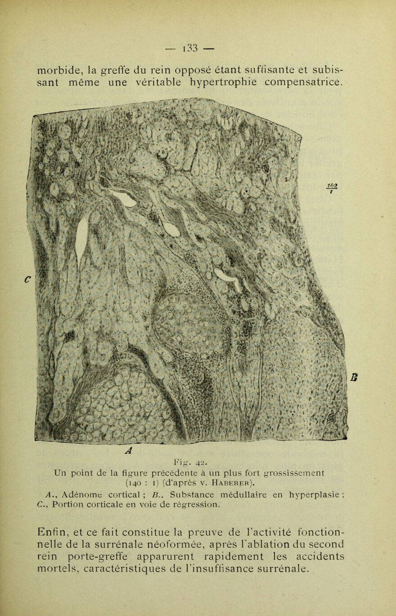 morbide, la greffe du rein opposé étant suffisante et subis- sant même une véritable hypertrophie compensatrice. A l'iy. Un point de la figure précédente à un plus fort grossissement (140 : I) (d’après v. Haberer). >1., Adénome cortical; B.. Substance médullaire en hyperplasie; C., Portion corticale en voie de régression. Enfin, et ce fait constitue la preuve de l’activité fonction- nelle de la surrénale néoformée, après l'ablation du second rein porte-greffe apparurent rapidement les accidents mortels, caractéristiques de l’insufhsance surrénale.