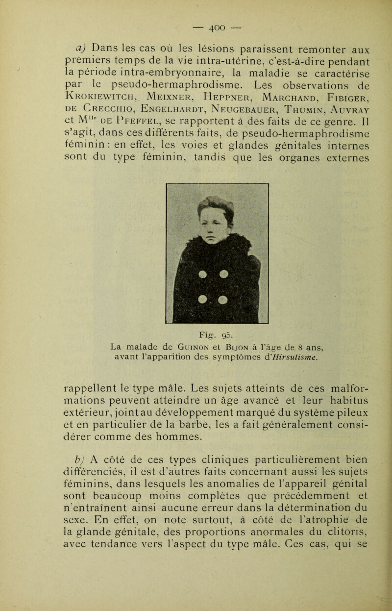 a) Dans les cas où les lésions paraissent remonter aux premiers temps de la vie intra-utérine, c’est-à-dire pendant la période intra-embryonnaire, la maladie se caractérise par le pseudo-hermaphrodisme. Les observations de Krokiewitch, Meixner, Heppner, Marchand, Fibiger, DE Crecchio, Engelhardt, Neugebauer, Thumin, Auvray et M'' DE Ffeffel, se rapportent à des faits de ce genre. Il s’agit, dans ces différents faits, de pseudo-hermaphrodisme féminin : en effet, les voies et glandes génitales internes sont du type féminin, tandis que les organes externes Fig-. 95. La malade de Guinon et Bijon à l’âge de 8 ans, avant l’apparition des symptômes d'Hirsutisme. rappellent le type mâle. Les sujets atteints de ces malfor- mations peuvent atteindre un âge avancé et leur habitus extérieur, jointau développement marqué du système pileux et en particulier de la barbe, les a fait généralement consi- dérer comme des hommes. b) A côté de ces types cliniques particulièrement bien différenciés, il est d’autres faits concernant aussi les sujets féminins, dans lesquels les anomalies de l’appareil génital sont beaucoup moins complètes que précédemment et n'entraînent ainsi aucune erreur dans la détermination du sexe. En effet, on note surtout, à côté de l’atrophie de la glande génitale, des proportions anormales du clitoris, avec tendance vers l'aspect du type mâle. Ces cas, qui se