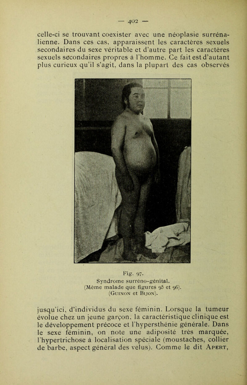 celle-ci se trouvant coexister avec une néoplasie surréna- lienne. Dans ces cas, apparaissent les caractères sexuels secondaires du sexe véritable et d’autre part les caractères sexuels secondaires propres à l’homme. Ce fait est d’autant plus curieux qu’il s’agit, dans la plupart des cas observés Fig-. 97- Syndrome surréno-génital. (Même malade que figures g5 et 96). (Guinon et Bijon). jusqu’ici, d’individus du sexe féminin. Lorsque la tumeur évolue chez un jeune garçon, la caractéristique clinique est le développement précoce et l’hypersthénie générale. Dans le sexe féminin, on note une adiposité très marquée, l’hypertrichose à localisation spéciale (moustaches, collier de barbe, aspect général des velus). Gomme le dit Apert,