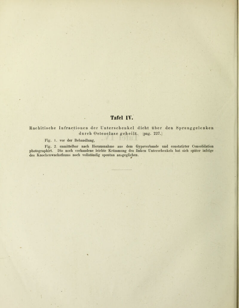 .Rachitische Infractionen der Unterschenkel dicht über den Sprunggelenken durch Osteoclase geheilt, (pag. 227.) Fig. I. vor der Behandlung, Fig. 2. unmittelbar nach Herausnahme aus dem Gypsverbande und constatirter Consolidation photographirt. Die noch vorhandene leichte Krümmung des linken Unterschenkels hat sich später infolge des Knochenwachsthums noch vollständig spontan ausgeglichen.