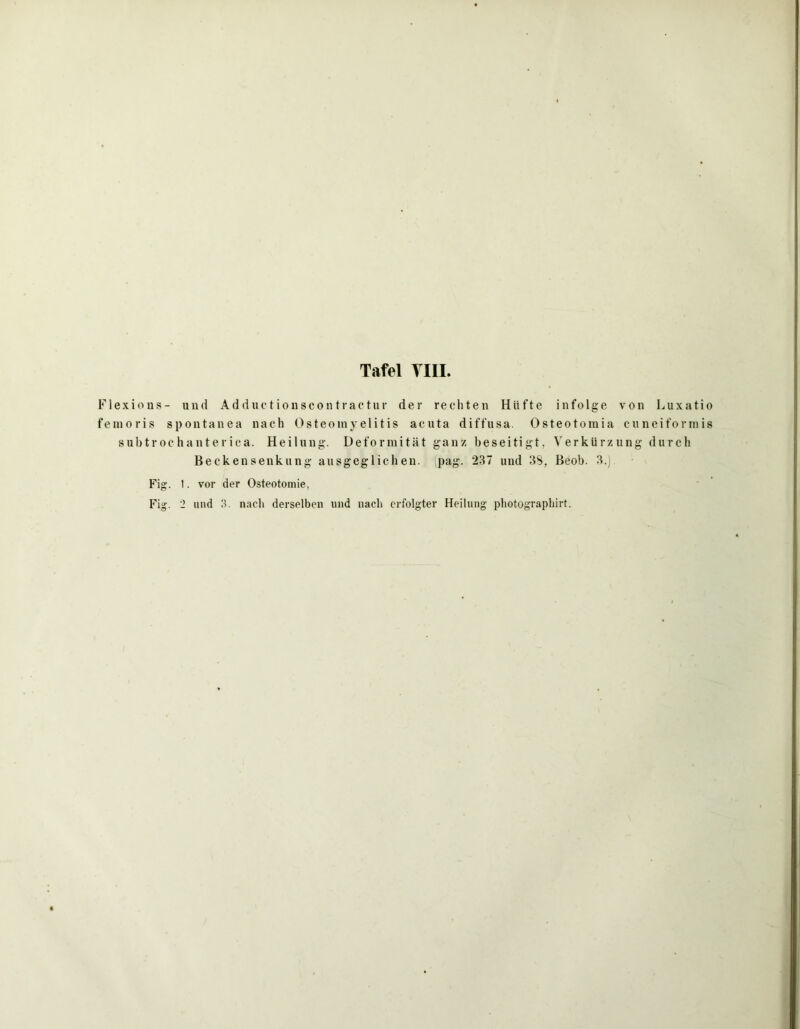 Flexions- und Adductionscontractur der rechten Hüfte infolge von Luxatio femoris spontanen nach Osteomyelitis acuta diffusa. Osteotomia cuneiformis subtrochanterica. Heilung. Deformität ganz beseitigt, Verkürzung durch Becken Senkung ausgeglichen, (pag. *237 und 38, Beob. 3.) Fig. 1. vor der Osteotomie, Fig. 2 und 3. nach derselben und nach erfolgter Heilung pliotographirt.