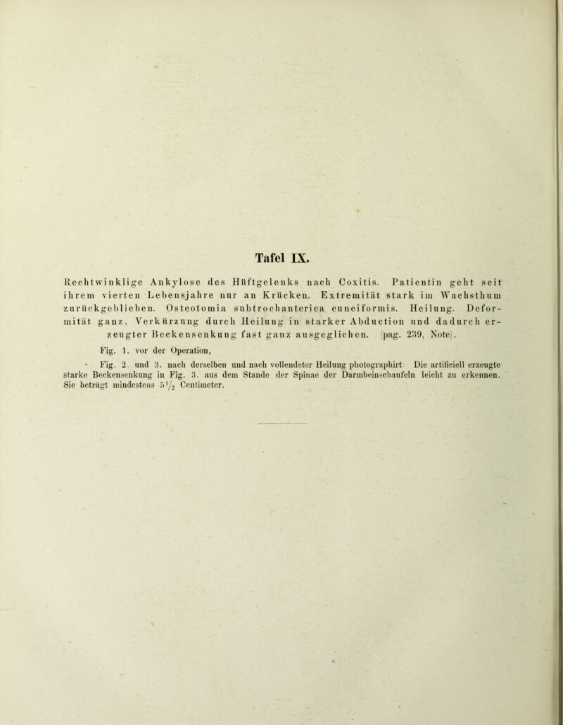 Rechtwinklige Ankylose des Hüftgelenks nach Coxitis. Patientin geht seit ihrem vierten Lebensjahre nur an Krücken. Extremität stark im Wachsthum zurückgeblieben. Osteotomia subtrochanterica cuneiformis. Heilung. Defor- mität ganz, Verkürzung durch Heilung in starker Abduction und dadurch er- zeugter Beckensenkung fast ganz ausgeglichen, (pag. 239, Note). Fig. 1. vor der Operation, ' Fig. 2. und 3. nach derselben und nach vollendeter Heilung photographirt Die artificiell erzeugte starke Beckensenkung in Fig. 3. aus dem Stande der Spinae der Darmbeinschaufeln leicht zu erkennen. Sie beträgt mindestens 5 ’/2 Centimeter.